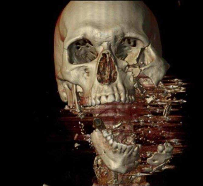 Alucinante imagen de una reconstrucción de cráneo de un #TC 3D, por el impacto de una bala en el rostro 

Los #TSID #Radiographer #TécnicosdeRadiología somos los profesionales sanitarios que realizamos estas pruebas de #Radiología y observamos las lesiones producidas 🩻☢️🩹