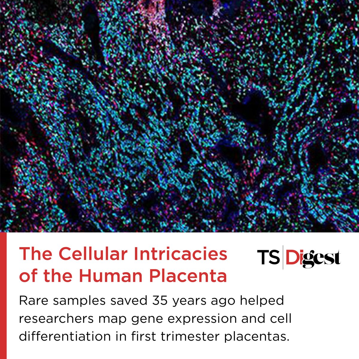 The Scientist (@thescientistllc) on Twitter photo The human placenta is unique and shrouded in mystery. Now, samples collected by <a href="/MoffettAm485/">Ashley Moffett</a> 35 years ago revealed the most detailed account of its invasion of the uterus to date. <a href="/IEmSteinmark/">I. Emilie Steinmark</a> reports. <a href="/nardhygomez/">Nardhy Gomez</a> @CamPathology <a href="/waynestate/">Wayne State University</a> bit.ly/43Ckhzm The human placenta is unique and shrouded in mystery. Now, samples collected by <a href="/MoffettAm485/">Ashley Moffett</a> 35 years ago revealed the most detailed account of its invasion of the uterus to date. <a href="/IEmSteinmark/">I. Emilie Steinmark</a> reports. <a href="/nardhygomez/">Nardhy Gomez</a> @CamPathology <a href="/waynestate/">Wayne State University</a> bit.ly/43Ckhzm