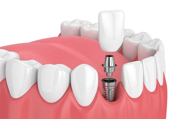 theNOBSdentist's tweet photo. Dental implants are viewed as our bionic escape from the woes of cavities.

“My teeth are jacked, I’ll just get implants eventually”

Implants have come a long way and a great *last resort* option for when a tooth must be extracted. 

Today I’m going to explain it all.

A few things before we start:
1) This is going to be LONG
2) Every patient has different needs, this post may or may not apply to you
3) I place and restore basic implants (not complex cases)
4) I will be fielding questions from my last tweet throughout this post
5) At the time of writing this intro, I have no idea how this will turn out since this is such a large topic with many textbooks dedicated to the subject (pray4me)

Let’s begin:

*What is a dental implant?*

I’m going to be blunt: A dental implant is a goddamn screw in your skull, typically made from titanium. It serves as a foundation for a replacement tooth or a dental bridge. The implant fuses with the bone in a process known as osseointegration, providing stable support for the artificial tooth. Then you put a tooth shaped crown (typically made of ceramic) on top of that screw. Now you have a complete dental implant. There are a few components to the implant:

the implant (the post or screw)
The abutment (this connects the screw to the visible tooth)
The crown (this is the white thing that looks like a tooth but its made of ceramic

*How does an implant stay in?*

An implant stays in place through osseointegration, where the implant fuses with the jawbone over time. Osseointegration is a good thing, but this does not make it a tooth. It’s not a dynamic part of your body like a tooth is. This secure attachment to the bone ensures the stability and durability of the implant, allowing it to function much like a natural tooth root.

*How does an implant differ from a real tooth?*

While an implant serves a similar function as a natural tooth, providing support and stability, it lacks the sensitivity and vitality of a real tooth since it's an artificial structure. An implant lacks a periodontal ligament. This means it’s going to FEEL different when you chew. The periodontal ligament that connects your teeth to your jaw provides a lot of sensory feedback, and implants do not have this. With that said, implants are not susceptible to dental diseases like cavities but require proper oral hygiene to maintain the health of the surrounding tissues.

You can get something called peri-implantitis. It’s a scary word but we’re going to break down what it means 

“peri” means around.

“implant” means the implant

“itis” means inflammation

Bringing it all together: the tissue around the implant is inflamed. While that doesn’t sound so scary anymore, it is scary because chronic peri-implantitis leads to one thing: failure of the implant.

*What if an implant fails?*

Implant failure happens. So many dentists tout the “95% success rate!!” But its a loaded statistic. In such cases, the failed implant likely needs to be removed, the site thoroughly cleaned, and a new implant may be placed after appropriate healing and preparation. 

Here's the most important thing about implant failure compared to a tooth infection:

Implant failure is usually a slow, relatively painless process compared to a tooth. Remember, a tooth is a living, dynamic part of your body with a sensory feedback loop SCREAMING at you something is wrong. This does not happen with implants. 

Implant failure is such a large topic, so for all my dental friends forgive me if I miss anything for I am an idiot to even attempt to do this on twitter.

https://t.co/aXkx8OCVvJ

There are multiple failure points for a dental implant

1. Host related reasons
Age and gender of the patient, smoking habits, systemic disease, and oral hygiene.

Age is not so much of a factor to be honest, most studies show a difference but not statistically significant. 

Smoking will increase your odds for failure rate, more on this at the bottom of the post. 

Osteoporosis has been shown to be a condition leading to higher incidence of implant failure.

Pregnancy is another factor in implant failure. The hormonal shift can indirectly cause per-implantitis leading to higher chance of failure.

https://t.co/i09bmFCmHv

Uncontrolled diabetes is also a factor for implant success rate. More on this towards the bottom (someone asked a specific question on this)

https://t.co/ftHPxaLajq

2. Location of implant placement
Position in arch, quality, and quantity of bone are implant placement site-related factors
Our skulls don’t have uniformly dense bone. There are classifications of bone density and they are as follows:

D1 - Dense cortical bone (found in the lower front jaw)
D2 - Porous cortical bone (lower back jaw, front upper jaw)
D3 -  Porous cortical/Fine Trabecular (front upper jaw, back upper jaw)
D4 - Fine trabecular (upper back jaw)

D1 is dense like an oak or maple wood, whereas D4 is like styrofoam. The denser the bone typically has a higher success rate for implant placement. These are general guidelines and it’s different in every person. 

3. Surgery-related reasons
Initial stability, angulations and direction of implant and the skillfulness of an operator come under surgery-related factors

Stability is exactly what it sounds like: how stable is the implant at the time of surgery? We measure this with the adeptly named Implant Stability Quotient (ISQ). It’s a little machine that looks like those forehead thermometers and it gives you a score. The more stable the implant at time of surgery, the better the outcome will likely be. 

Angulations are too annoying to cover on this and quite frankly, don’t worry about it lol. 

4. Implant fixture reasons
Surface roughness, length and diameter of dental implant, macrostructure and microstructure of an implant fixture.

This is getting deep into the weeds. Some studies show that implants with a diameter of greater than 11.5mm tend to show greater failure. Similarly, very narrow implants tend to fail faster than their wider counterparts.

The implant surface texture will also aid in implant success/failure
https://t.co/Jla2OcwLHw

There are also a variety of implant designs. Some are straight and conical, others are tapered. This is becoming quite overwhelming for dentists because there are so many goddamn implant systems and it seems like every week a rep calls saying they have the BEST NEW IMPLANT AND FAILURES ARE A THING OF THE PAST.
https://t.co/GNPtoxe1GU

5. Functional reasons
Type of prosthesis, retention method, and occlusal scheme are implant prosthesis-related factors

Immediately loading an implant with a crown can provide a patient with relief (for example, if you’re missing a front tooth and don’t want to walk around waiting for it to heal). If the crown is placed on the implant on the day of surgery, you want to make sure it’s not being banged on every time you chew. Many docs do it this way, but it can be a little unpredictable. The data supports it under the right conditions.
https://t.co/tnN2FWEhwF

The single greatest predictor of implant failure is an obvious but unexpected one: 

If you’ve had an implant fail before.
https://t.co/kvpEl6hszv

Your bite is one of the most important final steps in ensuring long term survival of the implant. This also rings true for teeth, but dentists can’t agree on occlusion so I won’t open that can of worms. 

I’ll put it simply so I annoy everyone: Implants don’t like to be pushed side to side, they only liked to be pushed up and down (axial forces).
https://t.co/aKTBdptZv8

*When do you decide to remove a tooth for an implant versus save it with a root canal?*

It depends. I know how many of you hate this answer but as you can see how many freaking variables go into the success of an implant, this is not a straightforward decision. I treat people, not teeth. Everyone has different circumstances.

*Are there long term things to be aware of?*

Long-term care of dental implants includes maintaining good oral hygiene to prevent diseases like peri-implantitis (an infection similar to gum disease that can lead to bone loss). Regular dental check-ups are crucial to monitor the condition of the implant and the surrounding tissues. 

If you diagnose peri-implantitis early, it can be managed. Things can do downhill fast, though. For example, a small insult to the implant like a piece of cement or food can start a cascade of inflammation that will lead to the failure of the implant in a matter of months. Unlike a tooth, it won't "hurt" signaling you to go get checked out.

*What type of materials are best for the “fake tooth”?*

I wouldn’t be concerned about this too much. It’s pretty much going to be one of two materials: lithium disilicate (emax) or zirconia. Both are great materials and have different pros and cons, rather than one being superior to the other. I try to match materials on opposing teeth due to surface similarity (zirconia opposes zirconia, etc). This is a whole different subject to be honest. 

One thing I will mention is that the connection between the fake tooth and the implant does matter. There is a much larger room for error when the crown is attached to the implant via cement rather than a screw. Granted there are exceptions, but I’d opt for a screw-retained implant crown 99% of the time (this gets dicey on the front teeth, but I will still stand by it). 

*Can you be allergic to titanium?*

While rare, allergic reactions to titanium have been reported. Symptoms can range from skin rashes to implant failure. I may get flamed for this section by other dentists on here but I don’t really care. 
Here’s the thing: 
The data shows titanium allergy is sparse, but data doesn’t rule everything. 

https://t.co/war2XEDoMv

The alternative to titanium implants are zirconia implants (AKA the entire screw is made of zirconia which is a type of ceramic). 

They have been growing in popularity but there’s one problem:

Ceramic can break. 

Believe me, you do NOT want an oral surgeon fishing out broken fragments of zirconia from your skull because your zirconia implant broke. It’s a nightmare, and anyone who tells you otherwise is being facetious. With that said, there are many people who successfully place zirconia implants, and their patients have no issues. I, for one, do not place these as the liability is way too high for my risk profile.

The literature shows that it osseointegrates similarly to titanium. Not only that, but the screw itself is white so it is a great option for implants in the esthetic zone. Soft tissue management in the front is a bitch, and you don’t want a silver screw poking through your thin gums. Again, this is beyond my risk profile… if a patient of mine wants one, to a surgeon you go.

https://t.co/ddtjL5H1Xq

https://t.co/EKSytAc0gH

*Should you wait for the extraction site to no longer be sore before getting the implant put in?*

Generally, it's recommended to allow the extraction site to heal fully before placing an implant. Soreness is not an indicator of healing as far as implant placement goes. The soreness you feel is usually due to the gums, which don't have much of an impact on the implant success rate. 

The bone needs to be sturdy to hold that implant. Think of mounting a TV. A non-integrated graft is like trying to hang a 90" TV in Drywall. It will go up on the wall, but in a few hours it'll fall down. However, in some cases, immediate placement may be possible.

Many people that want an immediate implant are also coming in with massively infected and broken teeth. You can’t place an implant at the time of extraction when you have a giant abscess in the base of your jaw. This is often the reason why you are declined an immediate implant placement on the day of extraction.

If the tooth is extracted with bone graft, you gotta wait a few months for that graft to integrate into your jaw. You don’t want to place an implant into mushy bone.

*What is a bone graft, and why do I need one?*

A bone graft is a procedure that augments or replaces bone in areas of tooth loss. It is needed when there's insufficient natural bone to support an implant, which can occur due to various reasons, including gum disease or long-term tooth loss. Many will use a xenograft or allograft.

Allografts: Made from human cadaver bone that has been thoroughly cleaned and sterilized. This bone is usually freeze-dried and demineralized, which leaves a matrix that can help stimulate new bone growth.

Xenografts: Typically made from bovine (cow) bone. The bone undergoes a rigorous cleaning and sterilization process to remove all organic material, leaving behind a mineral scaffold that aids in the regeneration of the patient's own bone.

As both are described as a “matrix” or scaffold” this means the bone graft needs to soak up your own blood and healing factors before it’s turned into hard, usable bone to support an implant.

That means one thing for you: waiting. 

You gotta wait a few months at least before you can even place an implant in that site.
*Can bone graft material for an implant harbor an infection similar to how a tooth can?*

It can, as anything can become infected. Way less likely though, and in this case a simple round of antibiotics and irrigation should do the trick.

*Is it best to get implants at/by a certain age?*

The one demographic I urge caution to: growing patients (children/teens). As I said before, dental implants are STATIC. They do not move like teeth do. 

In a growing patient, the jaw is still developing, which means that implant is going to be in an unpredictable position by the end of the growth phase. 

There isn’t really an age limit for placing implants, but you’ll find most 90 year olds don’t care to lol.

https://t.co/lvRmEDetJC

*If I have no tooth but I’m not in pain, do I need an implant?*

No, you don’t. Just keep in mind, teeth like partners. In an area with a missing tooth, expect the tooth behind it to drift forward and the tooth opposing it to drift/up or down looking for its long lost friend. It’s a tragic romance story.

*What is your opinion on zygomatic implants?*

Zygomatic implants, which anchor into the zygomatic bone (cheekbone), can be a last-resort solution for patients with severe bone loss in the upper jaw.

Let me say this clearly: ZYGOMATIC IMPLANTS ARE NO FREAKING JOKE.

I’m not going to get into the weeds of all this, but for the love of god do not let some corporate implant mill put zygo’s in. They are predictable when done by a skilled surgeon, but when they fail it is a MESS.

https://t.co/ka0tvZQzG9

https://t.co/qgULijnN12

*Can you be disqualified from being a candidate for implants if you have diabetes?*

While diabetes can affect healing, it does not automatically disqualify someone from receiving dental implants. However, blood sugar levels should be well-controlled before and during the healing process.

Uncontrolled diabetes and glucose dysregulation changes the way our body's immune system works. This means your implant becomes an easy target as your defenses are lowered.

*How does it feel to go through a dental implant versus a root canal?*

Both procedures are usually performed under local anesthesia, so discomfort during the procedure is minimal. Post-procedure pain varies among individuals and can be managed with medications.

It really depends on starting point. Do you have a massive infection? That’s going to make a root canal suck. Are you having 12 implants placed in one go and prone to inflammation? That’s going to make an implant procedure suck.

Ask any skilled surgeon, they will tell you it’s a bit of a dice roll on post-operative pain. I’ve had patients go directly back to work after both root canal or implant placement.

TLDR: It depends

*Are implants ok if you grind/clench?*

Grinding and clenching is a problem regardless of implants or not. It’s a serious issue that deserves investigating. With that said, implants do not like shear forces at all due to the nature of their osseointegration. 

Grinding and clenching will absolutely accelerate implant failure due to physical load. 

https://t.co/drU4MsmAQM

*What about implants in the front?*

Surgeons are going to hate this but they don’t deal with the backlash like restorative dentists do. They place the implant, it achieved primary stability and they send you on your way with a smile. 
That’s the end of their job. 

Your restorative dentist is in charge of making sure that implant looks good and functions well.

THIS IS INCREDIBLY DIFFICULT AND NOT THAT PREDICTABLE. Again, this is one of like 4 topics that probably needs its own dedicated post but I’ll do my best to distill this down:

The tissue is extremely temperamental in the esthetic zone, mainly due to the part of the bone called the buccal plate. The buccal plate can be easily explained as the thin bony casing that sits right under the gums behind your upper lip.

The buccal plate can get thin, even after initial placement with proper thickness. When the buccal plate gets thin, the tissue gets thin. When the tissue gets thin, it starts to look like SHIT because the metal screw starts to show.

We can mitigate this in a few ways
-Zirconia implants so the screw is white rather than silver
-Leveraging the power of pink ceramic to cover the exposed implant
-Soft tissue grafting

Regardless of the reparative measures, anyone who tells you anterior implants are easy are LIARS and tell them to come fight me.

https://t.co/n94JnQOfDr

*Can I continue smoking if I’m getting implants placed?*

This question pains me. If you get to a point where your teeth are compromised and implants are on your radar, you probably have a few areas of your lifestyle that need adjusting. I’m not going to point fingers and tell you how bad smoking is for your mouth and body, you already know that and you’re an adult. 

Anyway, yes…smoking is a major risk factor for implant failure. Will it happen to you? I don’t know, but if your case was on a roulette table in Vegas, my chips aren’t going in your square.

https://t.co/B2TRLcSq1I

YOU MADE IT TO THE FINISH LINE!

I don’t know why I volunteered to do this, because I’m sure I left some things out that will annoy fellow dentists, and I included way too much for the average person who’s interested in dental implants. The 4 image maximum is also a real buzzkill here, which I hope they fix.

 I hope you enjoyed this, but I’m not sure who this is for. Not a single patient in my office would want to read this but I know twitter probably does. I’m sure there will be follow up questions, so let me know in the comments what you think. 

I sincerely pray this was helpful and not a colossal waste of your time (and mine).