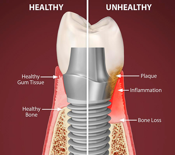 theNOBSdentist's tweet photo. Dental implants are viewed as our bionic escape from the woes of cavities.

“My teeth are jacked, I’ll just get implants eventually”

Implants have come a long way and a great *last resort* option for when a tooth must be extracted. 

Today I’m going to explain it all.

A few things before we start:
1) This is going to be LONG
2) Every patient has different needs, this post may or may not apply to you
3) I place and restore basic implants (not complex cases)
4) I will be fielding questions from my last tweet throughout this post
5) At the time of writing this intro, I have no idea how this will turn out since this is such a large topic with many textbooks dedicated to the subject (pray4me)

Let’s begin:

*What is a dental implant?*

I’m going to be blunt: A dental implant is a goddamn screw in your skull, typically made from titanium. It serves as a foundation for a replacement tooth or a dental bridge. The implant fuses with the bone in a process known as osseointegration, providing stable support for the artificial tooth. Then you put a tooth shaped crown (typically made of ceramic) on top of that screw. Now you have a complete dental implant. There are a few components to the implant:

the implant (the post or screw)
The abutment (this connects the screw to the visible tooth)
The crown (this is the white thing that looks like a tooth but its made of ceramic

*How does an implant stay in?*

An implant stays in place through osseointegration, where the implant fuses with the jawbone over time. Osseointegration is a good thing, but this does not make it a tooth. It’s not a dynamic part of your body like a tooth is. This secure attachment to the bone ensures the stability and durability of the implant, allowing it to function much like a natural tooth root.

*How does an implant differ from a real tooth?*

While an implant serves a similar function as a natural tooth, providing support and stability, it lacks the sensitivity and vitality of a real tooth since it's an artificial structure. An implant lacks a periodontal ligament. This means it’s going to FEEL different when you chew. The periodontal ligament that connects your teeth to your jaw provides a lot of sensory feedback, and implants do not have this. With that said, implants are not susceptible to dental diseases like cavities but require proper oral hygiene to maintain the health of the surrounding tissues.

You can get something called peri-implantitis. It’s a scary word but we’re going to break down what it means 

“peri” means around.

“implant” means the implant

“itis” means inflammation

Bringing it all together: the tissue around the implant is inflamed. While that doesn’t sound so scary anymore, it is scary because chronic peri-implantitis leads to one thing: failure of the implant.

*What if an implant fails?*

Implant failure happens. So many dentists tout the “95% success rate!!” But its a loaded statistic. In such cases, the failed implant likely needs to be removed, the site thoroughly cleaned, and a new implant may be placed after appropriate healing and preparation. 

Here's the most important thing about implant failure compared to a tooth infection:

Implant failure is usually a slow, relatively painless process compared to a tooth. Remember, a tooth is a living, dynamic part of your body with a sensory feedback loop SCREAMING at you something is wrong. This does not happen with implants. 

Implant failure is such a large topic, so for all my dental friends forgive me if I miss anything for I am an idiot to even attempt to do this on twitter.

https://t.co/aXkx8OCVvJ

There are multiple failure points for a dental implant

1. Host related reasons
Age and gender of the patient, smoking habits, systemic disease, and oral hygiene.

Age is not so much of a factor to be honest, most studies show a difference but not statistically significant. 

Smoking will increase your odds for failure rate, more on this at the bottom of the post. 

Osteoporosis has been shown to be a condition leading to higher incidence of implant failure.

Pregnancy is another factor in implant failure. The hormonal shift can indirectly cause per-implantitis leading to higher chance of failure.

https://t.co/i09bmFCmHv

Uncontrolled diabetes is also a factor for implant success rate. More on this towards the bottom (someone asked a specific question on this)

https://t.co/ftHPxaLajq

2. Location of implant placement
Position in arch, quality, and quantity of bone are implant placement site-related factors
Our skulls don’t have uniformly dense bone. There are classifications of bone density and they are as follows:

D1 - Dense cortical bone (found in the lower front jaw)
D2 - Porous cortical bone (lower back jaw, front upper jaw)
D3 -  Porous cortical/Fine Trabecular (front upper jaw, back upper jaw)
D4 - Fine trabecular (upper back jaw)

D1 is dense like an oak or maple wood, whereas D4 is like styrofoam. The denser the bone typically has a higher success rate for implant placement. These are general guidelines and it’s different in every person. 

3. Surgery-related reasons
Initial stability, angulations and direction of implant and the skillfulness of an operator come under surgery-related factors

Stability is exactly what it sounds like: how stable is the implant at the time of surgery? We measure this with the adeptly named Implant Stability Quotient (ISQ). It’s a little machine that looks like those forehead thermometers and it gives you a score. The more stable the implant at time of surgery, the better the outcome will likely be. 

Angulations are too annoying to cover on this and quite frankly, don’t worry about it lol. 

4. Implant fixture reasons
Surface roughness, length and diameter of dental implant, macrostructure and microstructure of an implant fixture.

This is getting deep into the weeds. Some studies show that implants with a diameter of greater than 11.5mm tend to show greater failure. Similarly, very narrow implants tend to fail faster than their wider counterparts.

The implant surface texture will also aid in implant success/failure
https://t.co/Jla2OcwLHw

There are also a variety of implant designs. Some are straight and conical, others are tapered. This is becoming quite overwhelming for dentists because there are so many goddamn implant systems and it seems like every week a rep calls saying they have the BEST NEW IMPLANT AND FAILURES ARE A THING OF THE PAST.
https://t.co/GNPtoxe1GU

5. Functional reasons
Type of prosthesis, retention method, and occlusal scheme are implant prosthesis-related factors

Immediately loading an implant with a crown can provide a patient with relief (for example, if you’re missing a front tooth and don’t want to walk around waiting for it to heal). If the crown is placed on the implant on the day of surgery, you want to make sure it’s not being banged on every time you chew. Many docs do it this way, but it can be a little unpredictable. The data supports it under the right conditions.
https://t.co/tnN2FWEhwF

The single greatest predictor of implant failure is an obvious but unexpected one: 

If you’ve had an implant fail before.
https://t.co/kvpEl6hszv

Your bite is one of the most important final steps in ensuring long term survival of the implant. This also rings true for teeth, but dentists can’t agree on occlusion so I won’t open that can of worms. 

I’ll put it simply so I annoy everyone: Implants don’t like to be pushed side to side, they only liked to be pushed up and down (axial forces).
https://t.co/aKTBdptZv8

*When do you decide to remove a tooth for an implant versus save it with a root canal?*

It depends. I know how many of you hate this answer but as you can see how many freaking variables go into the success of an implant, this is not a straightforward decision. I treat people, not teeth. Everyone has different circumstances.

*Are there long term things to be aware of?*

Long-term care of dental implants includes maintaining good oral hygiene to prevent diseases like peri-implantitis (an infection similar to gum disease that can lead to bone loss). Regular dental check-ups are crucial to monitor the condition of the implant and the surrounding tissues. 

If you diagnose peri-implantitis early, it can be managed. Things can do downhill fast, though. For example, a small insult to the implant like a piece of cement or food can start a cascade of inflammation that will lead to the failure of the implant in a matter of months. Unlike a tooth, it won't "hurt" signaling you to go get checked out.

*What type of materials are best for the “fake tooth”?*

I wouldn’t be concerned about this too much. It’s pretty much going to be one of two materials: lithium disilicate (emax) or zirconia. Both are great materials and have different pros and cons, rather than one being superior to the other. I try to match materials on opposing teeth due to surface similarity (zirconia opposes zirconia, etc). This is a whole different subject to be honest. 

One thing I will mention is that the connection between the fake tooth and the implant does matter. There is a much larger room for error when the crown is attached to the implant via cement rather than a screw. Granted there are exceptions, but I’d opt for a screw-retained implant crown 99% of the time (this gets dicey on the front teeth, but I will still stand by it). 

*Can you be allergic to titanium?*

While rare, allergic reactions to titanium have been reported. Symptoms can range from skin rashes to implant failure. I may get flamed for this section by other dentists on here but I don’t really care. 
Here’s the thing: 
The data shows titanium allergy is sparse, but data doesn’t rule everything. 

https://t.co/war2XEDoMv

The alternative to titanium implants are zirconia implants (AKA the entire screw is made of zirconia which is a type of ceramic). 

They have been growing in popularity but there’s one problem:

Ceramic can break. 

Believe me, you do NOT want an oral surgeon fishing out broken fragments of zirconia from your skull because your zirconia implant broke. It’s a nightmare, and anyone who tells you otherwise is being facetious. With that said, there are many people who successfully place zirconia implants, and their patients have no issues. I, for one, do not place these as the liability is way too high for my risk profile.

The literature shows that it osseointegrates similarly to titanium. Not only that, but the screw itself is white so it is a great option for implants in the esthetic zone. Soft tissue management in the front is a bitch, and you don’t want a silver screw poking through your thin gums. Again, this is beyond my risk profile… if a patient of mine wants one, to a surgeon you go.

https://t.co/ddtjL5H1Xq

https://t.co/EKSytAc0gH

*Should you wait for the extraction site to no longer be sore before getting the implant put in?*

Generally, it's recommended to allow the extraction site to heal fully before placing an implant. Soreness is not an indicator of healing as far as implant placement goes. The soreness you feel is usually due to the gums, which don't have much of an impact on the implant success rate. 

The bone needs to be sturdy to hold that implant. Think of mounting a TV. A non-integrated graft is like trying to hang a 90" TV in Drywall. It will go up on the wall, but in a few hours it'll fall down. However, in some cases, immediate placement may be possible.

Many people that want an immediate implant are also coming in with massively infected and broken teeth. You can’t place an implant at the time of extraction when you have a giant abscess in the base of your jaw. This is often the reason why you are declined an immediate implant placement on the day of extraction.

If the tooth is extracted with bone graft, you gotta wait a few months for that graft to integrate into your jaw. You don’t want to place an implant into mushy bone.

*What is a bone graft, and why do I need one?*

A bone graft is a procedure that augments or replaces bone in areas of tooth loss. It is needed when there's insufficient natural bone to support an implant, which can occur due to various reasons, including gum disease or long-term tooth loss. Many will use a xenograft or allograft.

Allografts: Made from human cadaver bone that has been thoroughly cleaned and sterilized. This bone is usually freeze-dried and demineralized, which leaves a matrix that can help stimulate new bone growth.

Xenografts: Typically made from bovine (cow) bone. The bone undergoes a rigorous cleaning and sterilization process to remove all organic material, leaving behind a mineral scaffold that aids in the regeneration of the patient's own bone.

As both are described as a “matrix” or scaffold” this means the bone graft needs to soak up your own blood and healing factors before it’s turned into hard, usable bone to support an implant.

That means one thing for you: waiting. 

You gotta wait a few months at least before you can even place an implant in that site.
*Can bone graft material for an implant harbor an infection similar to how a tooth can?*

It can, as anything can become infected. Way less likely though, and in this case a simple round of antibiotics and irrigation should do the trick.

*Is it best to get implants at/by a certain age?*

The one demographic I urge caution to: growing patients (children/teens). As I said before, dental implants are STATIC. They do not move like teeth do. 

In a growing patient, the jaw is still developing, which means that implant is going to be in an unpredictable position by the end of the growth phase. 

There isn’t really an age limit for placing implants, but you’ll find most 90 year olds don’t care to lol.

https://t.co/lvRmEDetJC

*If I have no tooth but I’m not in pain, do I need an implant?*

No, you don’t. Just keep in mind, teeth like partners. In an area with a missing tooth, expect the tooth behind it to drift forward and the tooth opposing it to drift/up or down looking for its long lost friend. It’s a tragic romance story.

*What is your opinion on zygomatic implants?*

Zygomatic implants, which anchor into the zygomatic bone (cheekbone), can be a last-resort solution for patients with severe bone loss in the upper jaw.

Let me say this clearly: ZYGOMATIC IMPLANTS ARE NO FREAKING JOKE.

I’m not going to get into the weeds of all this, but for the love of god do not let some corporate implant mill put zygo’s in. They are predictable when done by a skilled surgeon, but when they fail it is a MESS.

https://t.co/ka0tvZQzG9

https://t.co/qgULijnN12

*Can you be disqualified from being a candidate for implants if you have diabetes?*

While diabetes can affect healing, it does not automatically disqualify someone from receiving dental implants. However, blood sugar levels should be well-controlled before and during the healing process.

Uncontrolled diabetes and glucose dysregulation changes the way our body's immune system works. This means your implant becomes an easy target as your defenses are lowered.

*How does it feel to go through a dental implant versus a root canal?*

Both procedures are usually performed under local anesthesia, so discomfort during the procedure is minimal. Post-procedure pain varies among individuals and can be managed with medications.

It really depends on starting point. Do you have a massive infection? That’s going to make a root canal suck. Are you having 12 implants placed in one go and prone to inflammation? That’s going to make an implant procedure suck.

Ask any skilled surgeon, they will tell you it’s a bit of a dice roll on post-operative pain. I’ve had patients go directly back to work after both root canal or implant placement.

TLDR: It depends

*Are implants ok if you grind/clench?*

Grinding and clenching is a problem regardless of implants or not. It’s a serious issue that deserves investigating. With that said, implants do not like shear forces at all due to the nature of their osseointegration. 

Grinding and clenching will absolutely accelerate implant failure due to physical load. 

https://t.co/drU4MsmAQM

*What about implants in the front?*

Surgeons are going to hate this but they don’t deal with the backlash like restorative dentists do. They place the implant, it achieved primary stability and they send you on your way with a smile. 
That’s the end of their job. 

Your restorative dentist is in charge of making sure that implant looks good and functions well.

THIS IS INCREDIBLY DIFFICULT AND NOT THAT PREDICTABLE. Again, this is one of like 4 topics that probably needs its own dedicated post but I’ll do my best to distill this down:

The tissue is extremely temperamental in the esthetic zone, mainly due to the part of the bone called the buccal plate. The buccal plate can be easily explained as the thin bony casing that sits right under the gums behind your upper lip.

The buccal plate can get thin, even after initial placement with proper thickness. When the buccal plate gets thin, the tissue gets thin. When the tissue gets thin, it starts to look like SHIT because the metal screw starts to show.

We can mitigate this in a few ways
-Zirconia implants so the screw is white rather than silver
-Leveraging the power of pink ceramic to cover the exposed implant
-Soft tissue grafting

Regardless of the reparative measures, anyone who tells you anterior implants are easy are LIARS and tell them to come fight me.

https://t.co/n94JnQOfDr

*Can I continue smoking if I’m getting implants placed?*

This question pains me. If you get to a point where your teeth are compromised and implants are on your radar, you probably have a few areas of your lifestyle that need adjusting. I’m not going to point fingers and tell you how bad smoking is for your mouth and body, you already know that and you’re an adult. 

Anyway, yes…smoking is a major risk factor for implant failure. Will it happen to you? I don’t know, but if your case was on a roulette table in Vegas, my chips aren’t going in your square.

https://t.co/B2TRLcSq1I

YOU MADE IT TO THE FINISH LINE!

I don’t know why I volunteered to do this, because I’m sure I left some things out that will annoy fellow dentists, and I included way too much for the average person who’s interested in dental implants. The 4 image maximum is also a real buzzkill here, which I hope they fix.

 I hope you enjoyed this, but I’m not sure who this is for. Not a single patient in my office would want to read this but I know twitter probably does. I’m sure there will be follow up questions, so let me know in the comments what you think. 

I sincerely pray this was helpful and not a colossal waste of your time (and mine).