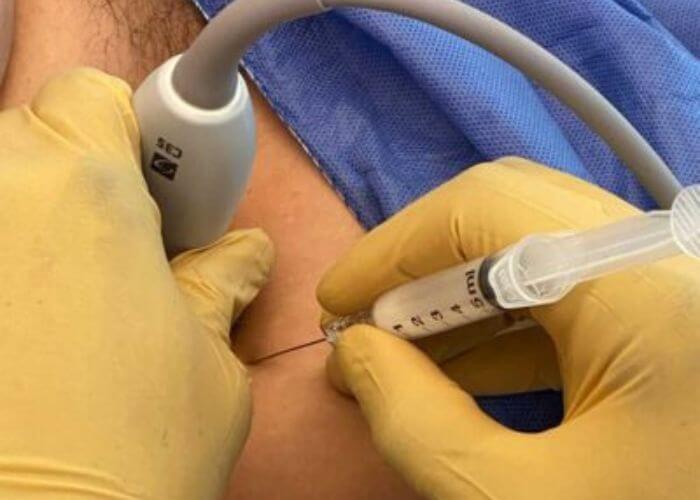 bennwachukwumd's tweet photo. Are there different kinds of #hipinjections?
I offer several different types of ultrasound-guided hip injections including steroid, gel, and #plateletrichplasma. Learn more here: https://t.co/303OQueMix #orthotwitter #hipinjection https://t.co/WYfN7emuIS