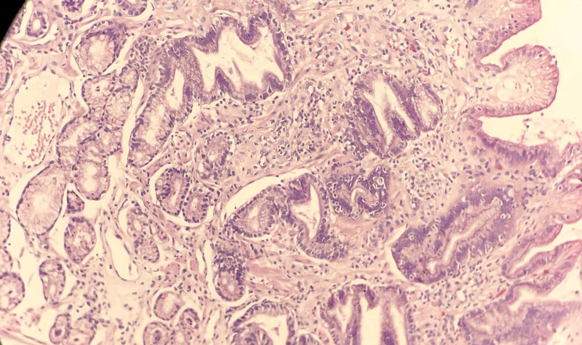 missnzzhat's tweet photo. 🟢 EGD: 🍉 stomach
🟡 Features of :
Reactive gastropathy ➕ Fibrin thrombi
🟠 Gastric antral vascular ectasia
#gipath #pathtwitter https://t.co/ES0MMBgeP8
