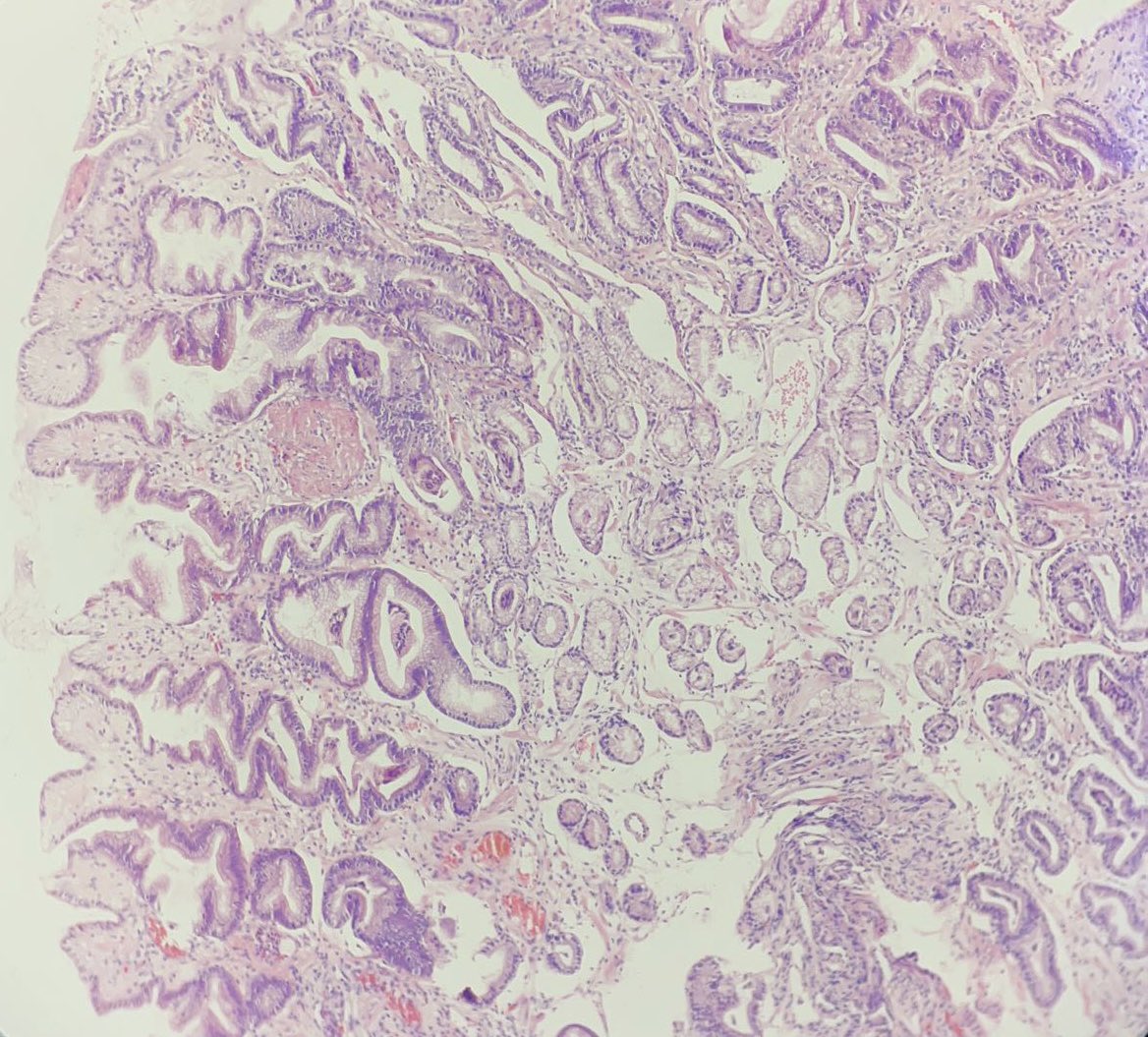 missnzzhat's tweet photo. 🟢 EGD: 🍉 stomach
🟡 Features of :
Reactive gastropathy ➕ Fibrin thrombi
🟠 Gastric antral vascular ectasia
#gipath #pathtwitter https://t.co/ES0MMBgeP8