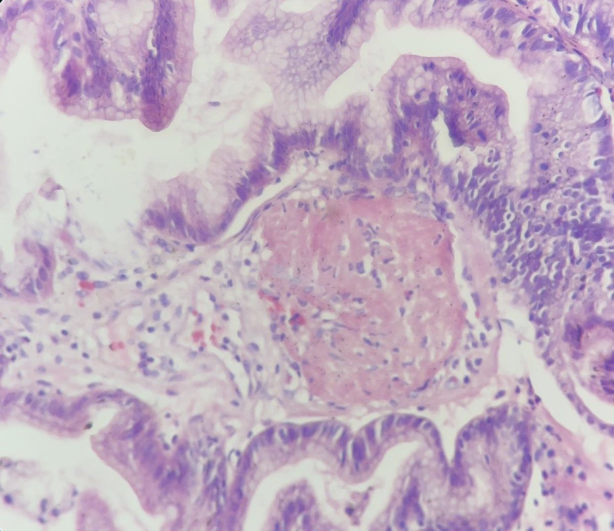 missnzzhat's tweet photo. 🟢 EGD: 🍉 stomach
🟡 Features of :
Reactive gastropathy ➕ Fibrin thrombi
🟠 Gastric antral vascular ectasia
#gipath #pathtwitter https://t.co/ES0MMBgeP8