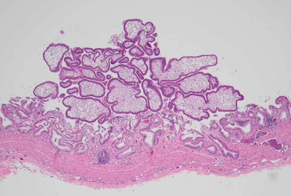 MhPathology's tweet image. Cholecystic archipelago.
Cholesterol Polyp (Gallbladder)#PathTwitter #medpath #gipath
