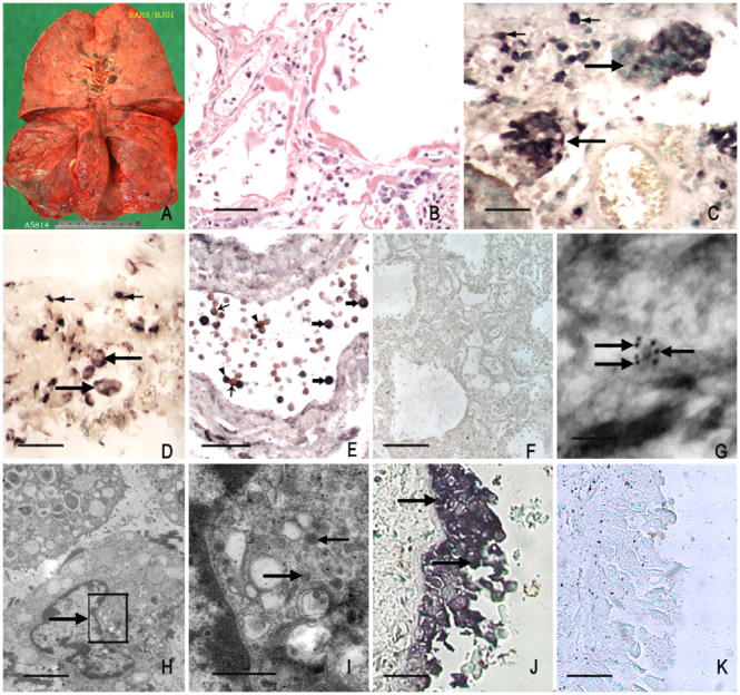 2) ... bronchi, distal renal tubules, mucosa, and submucosa of the intestines, and neurons of the brain."

Fig. SARS pathology in the respiratory tract. Lung of a SARS victim