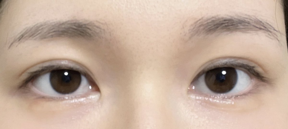 れい 二重切開後 tweet media