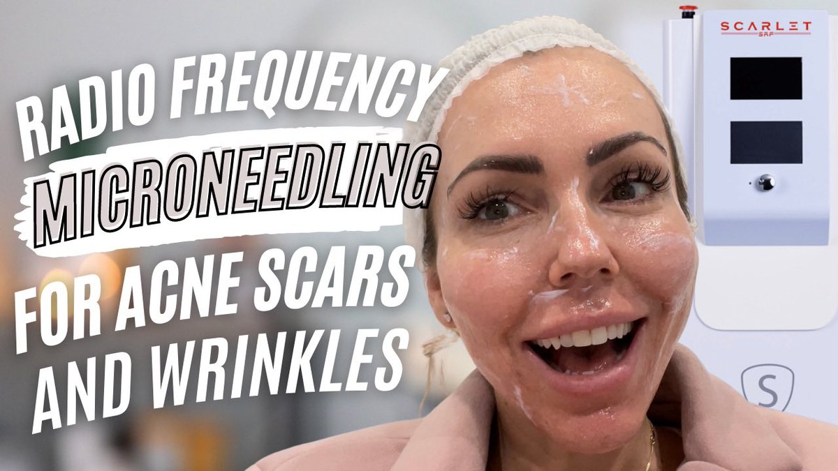 KassandraBrooks's tweet photo. https://t.co/CZNR0OFnAx
#acne #acnescars https://t.co/z0Ta9heckA