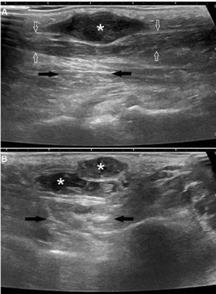 Enfermedad de Ledderhose o fibromatosis plantar.

Traemos el #ArtículoRecomendadoDelLunes 🕵

➡️ buff.ly/3Pu91l9

#FOAMrad #FOAMed <a href="/SERAM_RX/">SERAM - Sociedad Española de Radiología Médica</a> @mkserme