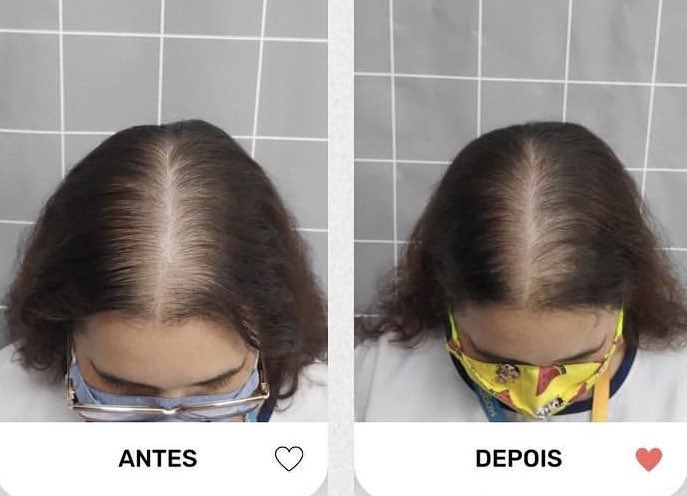 vanessamachadoa's tweet photo. Hoje, às 20h, acontecerá uma live na qual eu e Andrieli Richter, da Dermociencia, falaremos sobre queda de cabelo. Inclusive, vamos falar sobre tratamento para esse problema que tanto nos afeta. Espero vocês às 20h no meu canal do YouTube. Imperdível! Bj
https://t.co/jchjiRbxDj https://t.co/zzWcsorDKN