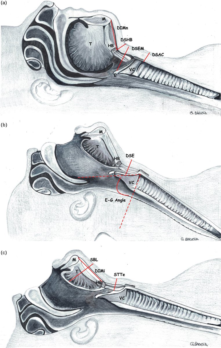 Pre-operative ultrasound prediction of difficult airway management in adult patients

The thickness of the anterior neck soft tissue is related to a difficult airway and ultrasound-based measures are as accurate as CT or MRI scans.

🔗ow.ly/myEa50Pp6vg