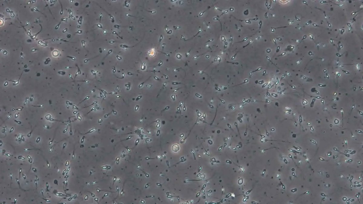 👱🏼La #Normozoospermie est diagnostiquée lorsque le sperme répond aux paramètres de normalité établis par l'Organisation mondiale de la santé. Cependant, cela ne garantit pas qu'il n'y a pas de problème de #fertilite.
#facteurmasculin 📹 bit.ly/2L2V3EW