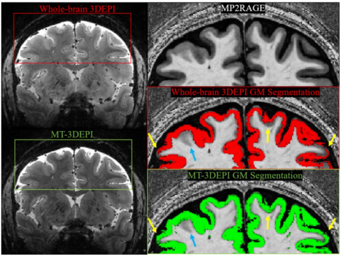 New layer-fMRI paper that promotes MT-prepared segmented 3D-EPI to mitigate layer-fMRI analysis issues of tissue-type segmentation and structure-function alignment.
By Vahid Malekian et al., 
doi.org/10.1016/j.neur…