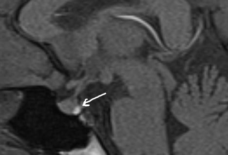 drmankad's tweet photo. Tip of the day 💡: Absence of the normal posterior pituitary bright spot is associated strongly with central diabetes insipidus. Do you know why is the posterior pituitary normally T1 bright? https://t.co/AvwTUQTrj4