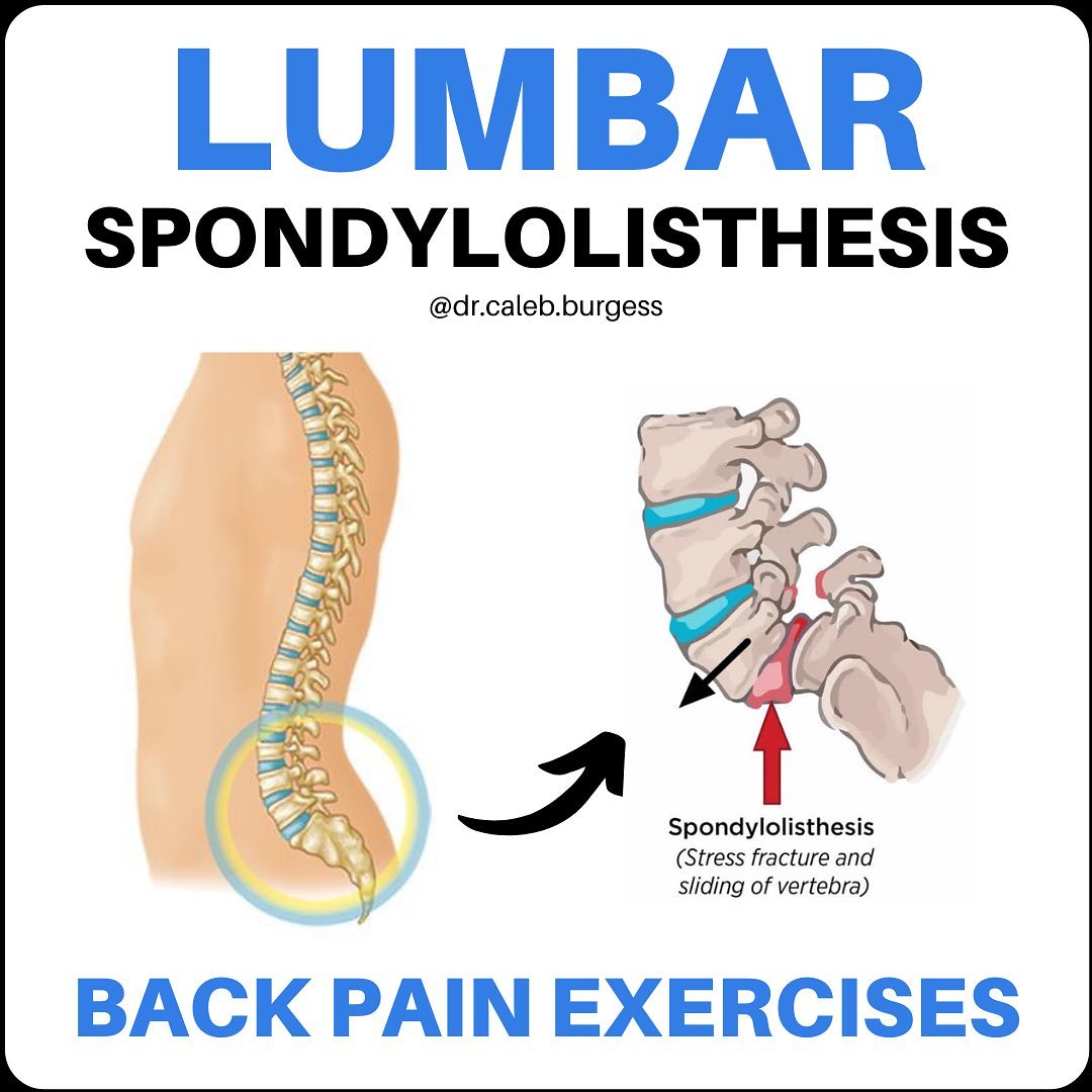Lumbar Spondylolisthesis; Back Pain Exercise save this...