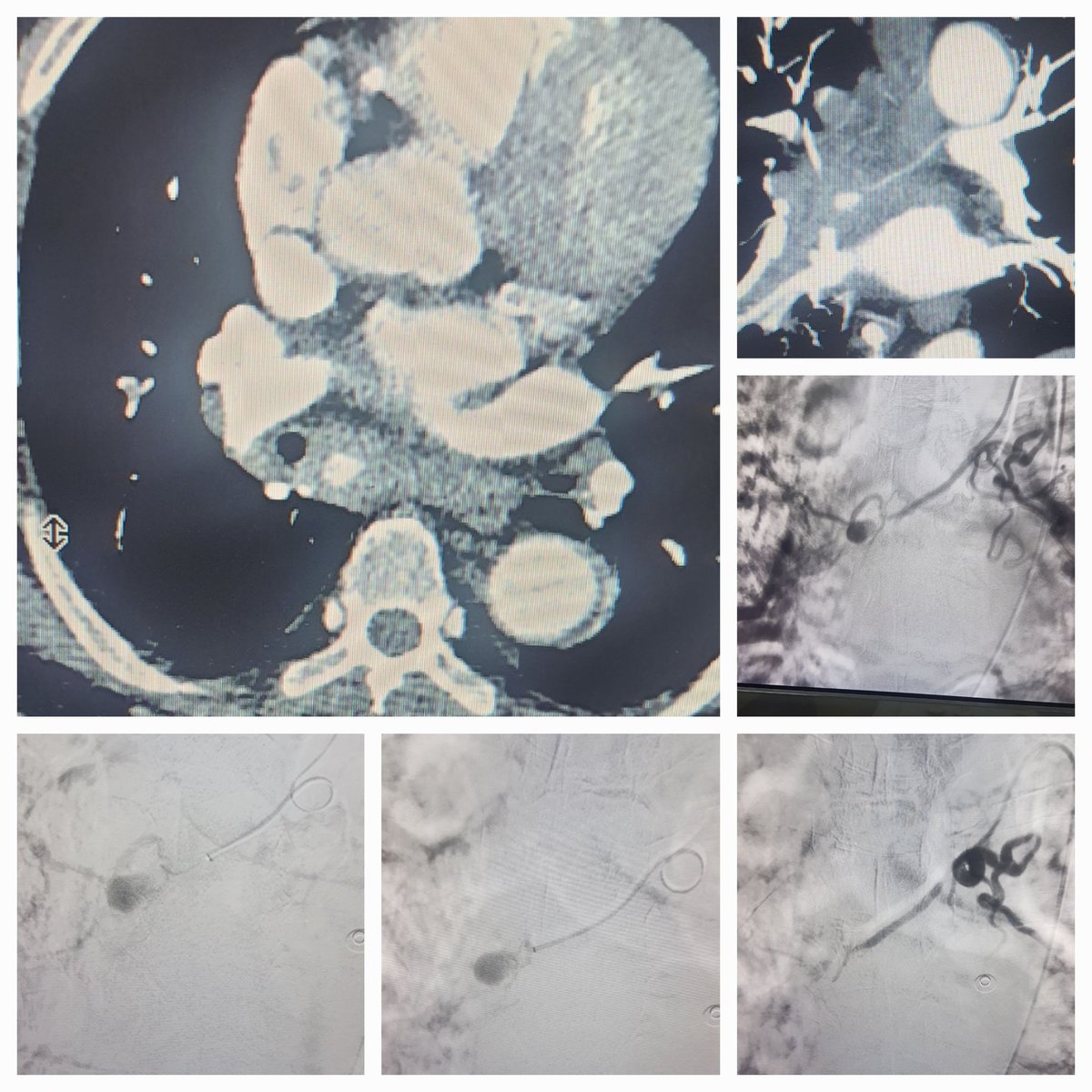 Dr Saurabh kumar Interventional radiologist tweet media