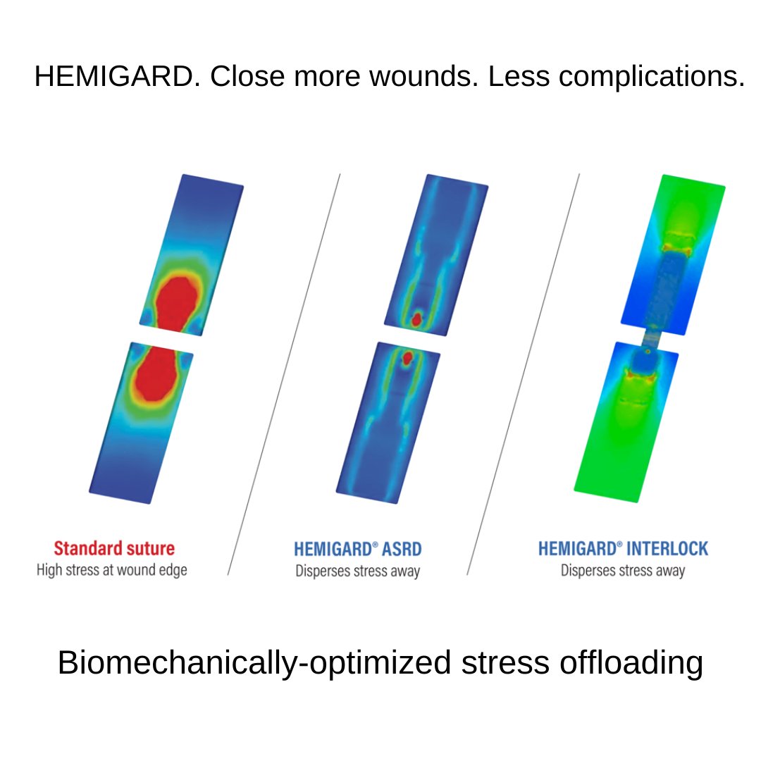 HEMIGARD devices have DIFFERENTIAL STIFFNESS and gently offload stress from skin wound edges. HEMIGARD ASRD is used with sutures to offload up to 40N and HEMIGARD Interlock offloads up to 20N without punctures. Improve outcomes and save time. #hemigard #differentialstiffness