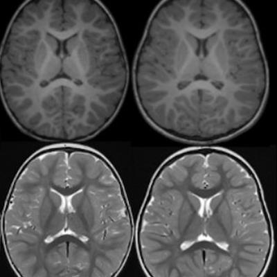AuntMinnie's tweet image. Deep learning helps radiologists predict pediatric myelin maturation age #radiology #ImagingAI bit.ly/44L2kQP