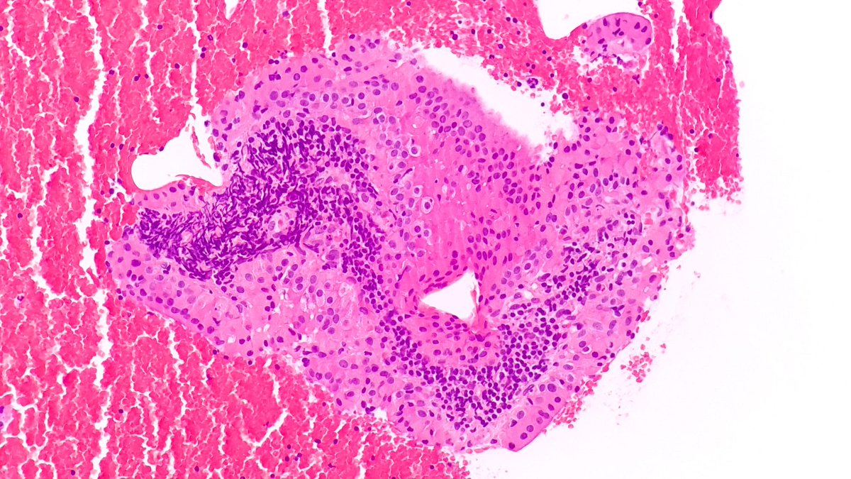 Tumor de Warthin👀:
🔸2º tumor más frecuente de glándula salival (⬆️parótida). 6º-7º década🧑‍🦳.
🔸Benigno.
🔸Alta asociación con🚬.
🔸Clínica: masa indolora de crecimiento lento.
🔸🔬: componente epitelial (oncocítico y papilar) y linfoide.
🔸Dg citológico por PAAF
#ENTPath