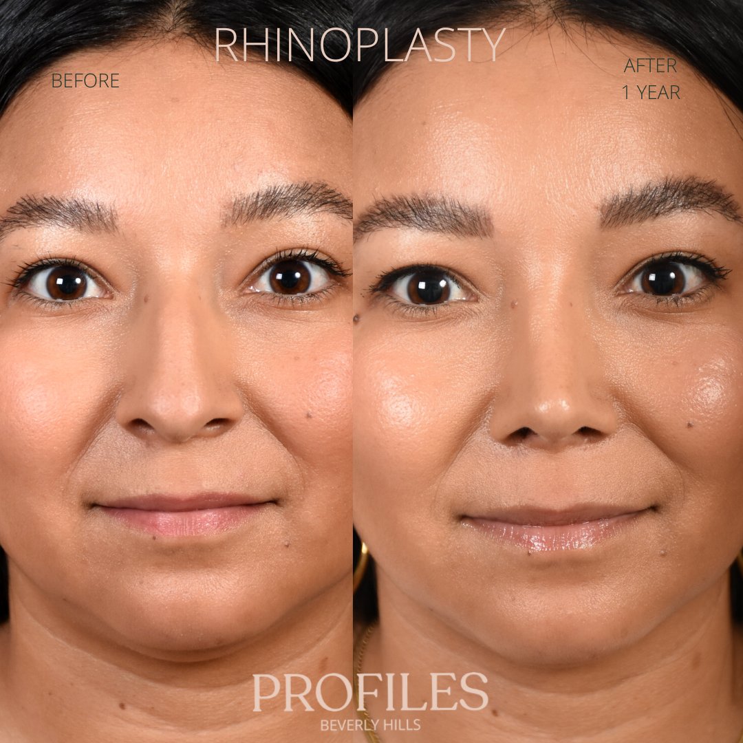 FacialPlastics's tweet photo. 📞310-276-6800
🏠 435 N Bedford Drive, PH500, Beverly Hills, 90210
👃Rhinoplasty
🗓 Before and After 1 Year
🛏 About 1 week, the cast gets taken off after 6 days

Swipe ⏩⏩⏩ for more views

Call or DM us to schedule your consultation

We also offer virtual cons... https://t.co/L8vhJ6VZ54