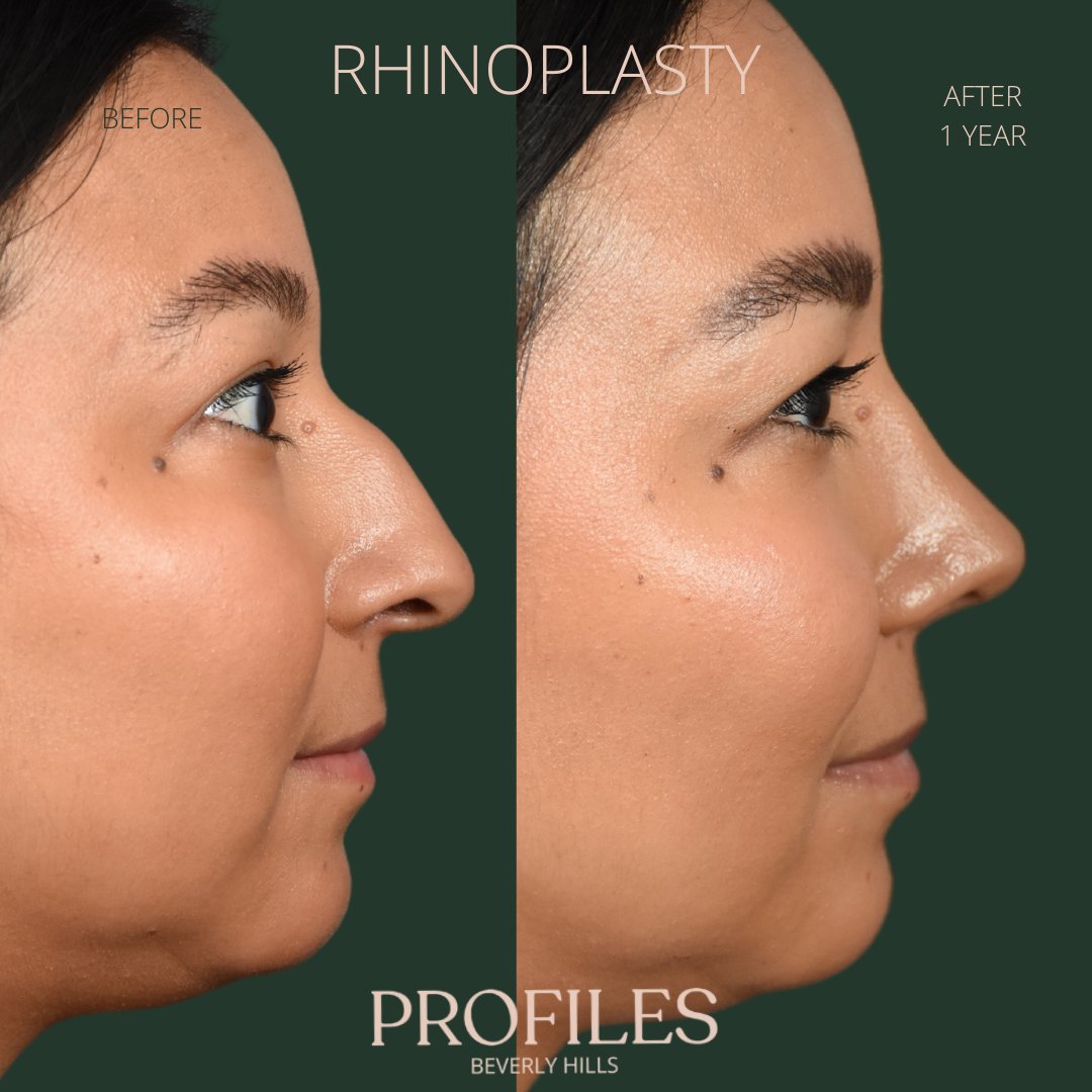 FacialPlastics's tweet photo. 📞310-276-6800
🏠 435 N Bedford Drive, PH500, Beverly Hills, 90210
👃Rhinoplasty
🗓 Before and After 1 Year
🛏 About 1 week, the cast gets taken off after 6 days

Swipe ⏩⏩⏩ for more views

Call or DM us to schedule your consultation

We also offer virtual cons... https://t.co/L8vhJ6VZ54