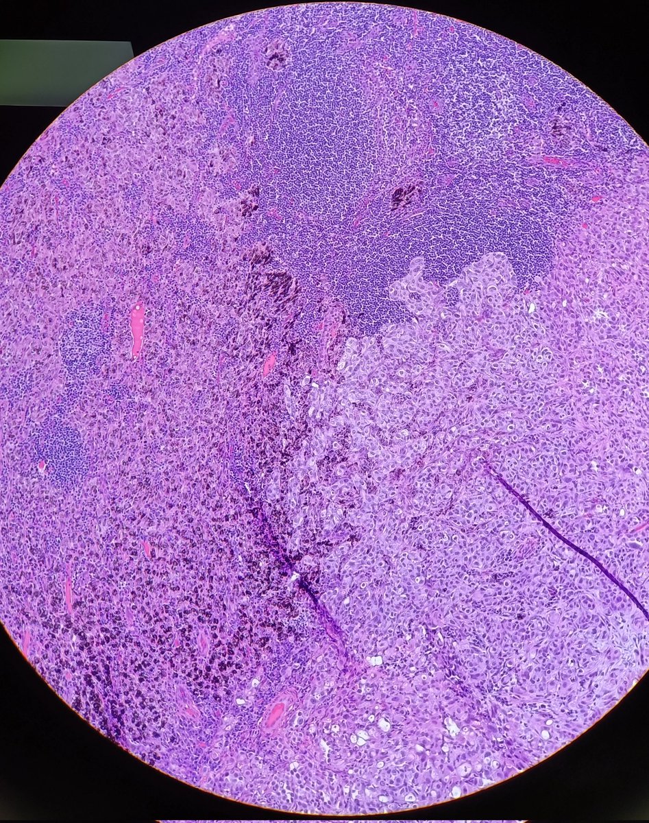 Appreciating this lymph node with mets. Three different sections seen