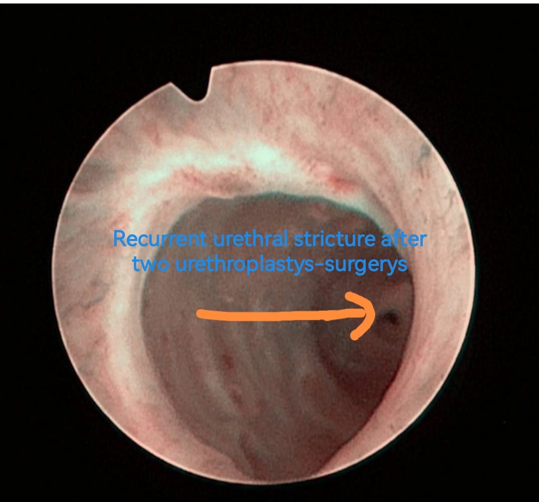 OTosev's tweet photo. Can #Optilume treatment help after urethroplasty surgery?The answer is YES, even after 2 urethroplasty surgeries! With a help of our wonderful https://t.co/Kp4p9GaadA.univ. Georgi #Tosev. https://t.co/goWwWPL9jT