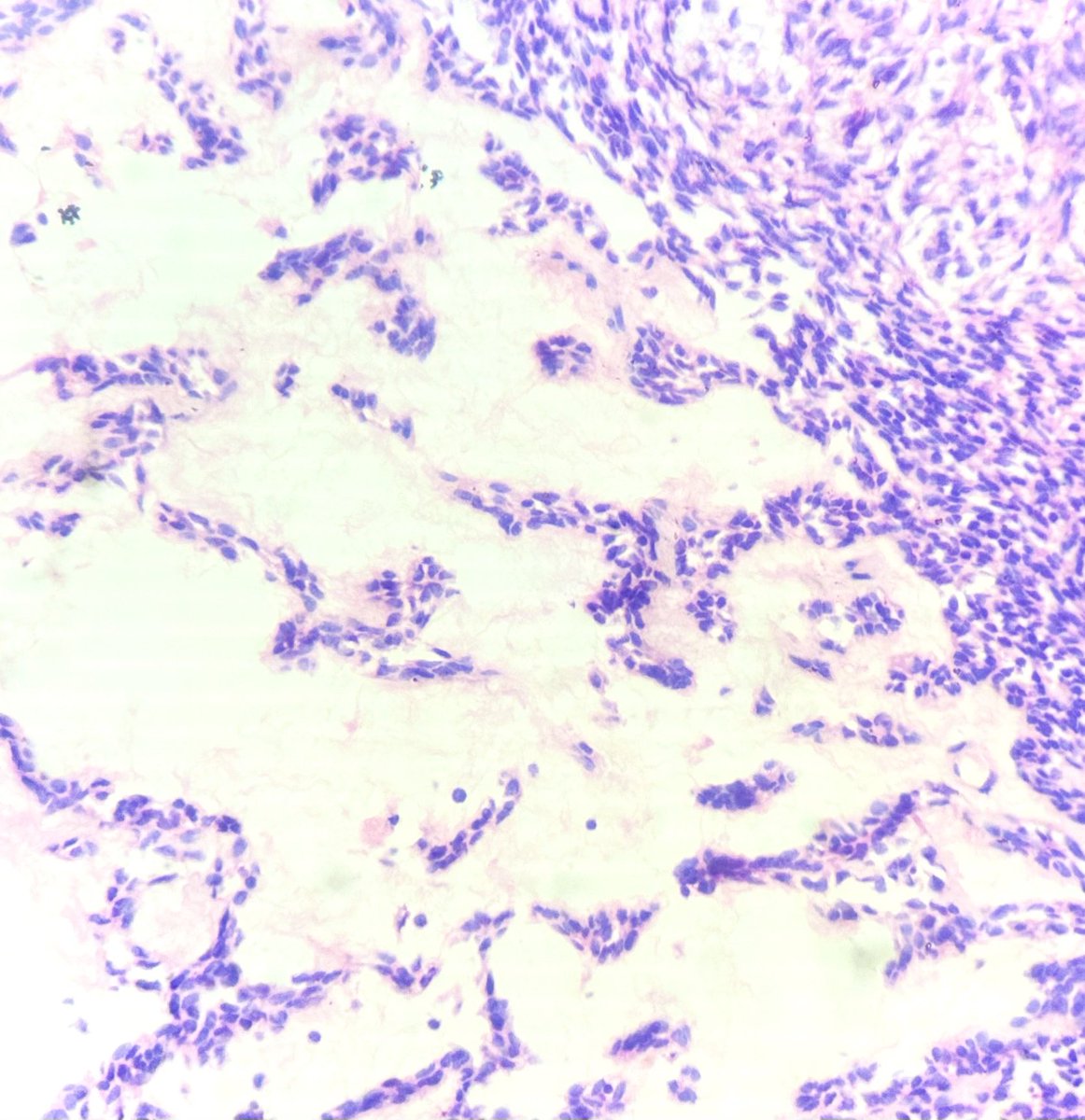 NidhinMd's tweet photo. Solid cystic lesion in the Maxilla of a 52 year old lady #pathology #PathTwitter #histopath #ameloblastoma #resident #adenoameloblastoma #twitterpath #interestingcase #pathologic #doctor https://t.co/cWRbzZbYX7