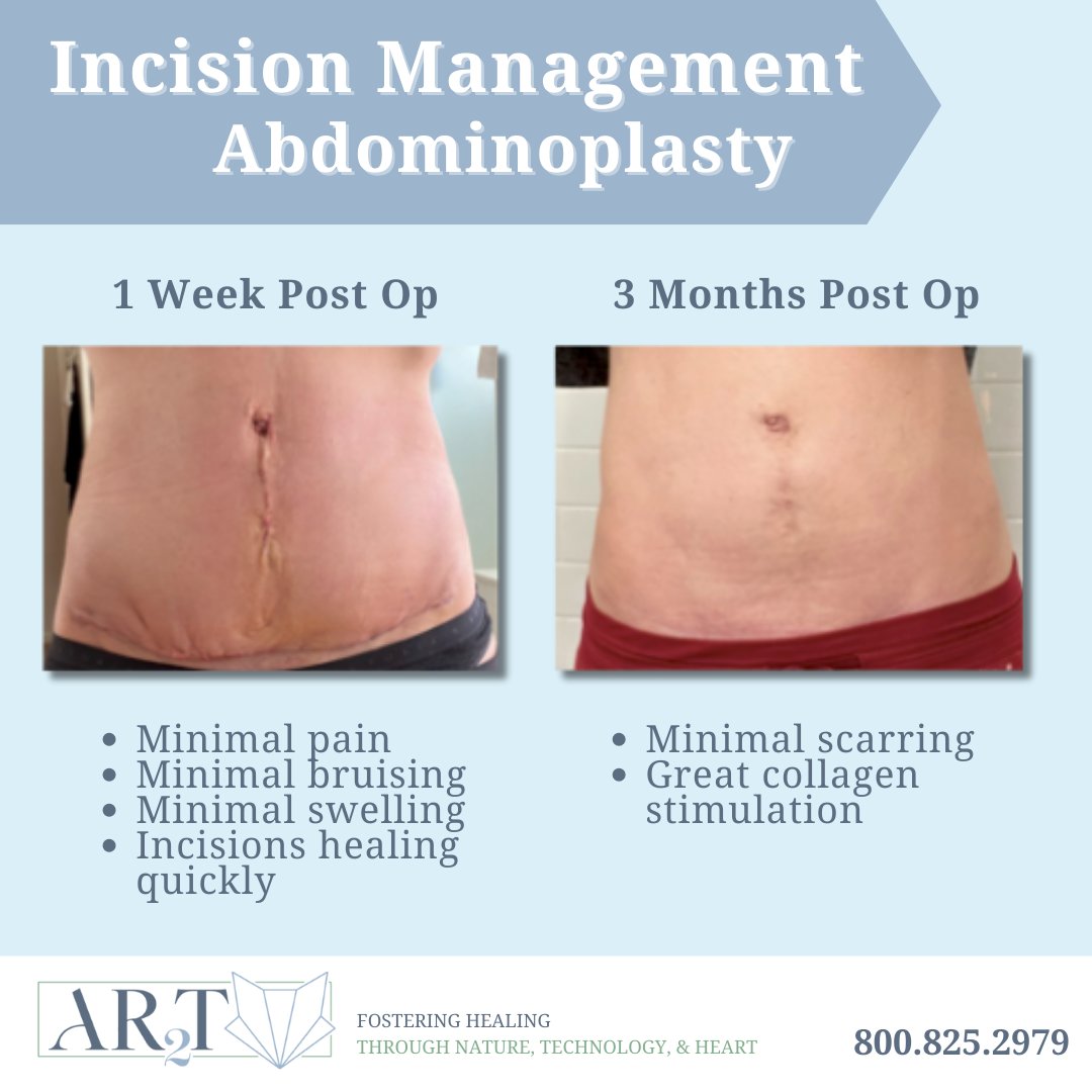 Incision Management with CDO Therapy:
• Pain reduction
• Scar reduction
• Faster healing time

#incisionmanagement #plastics #abdominalsurgery #electivesurgery