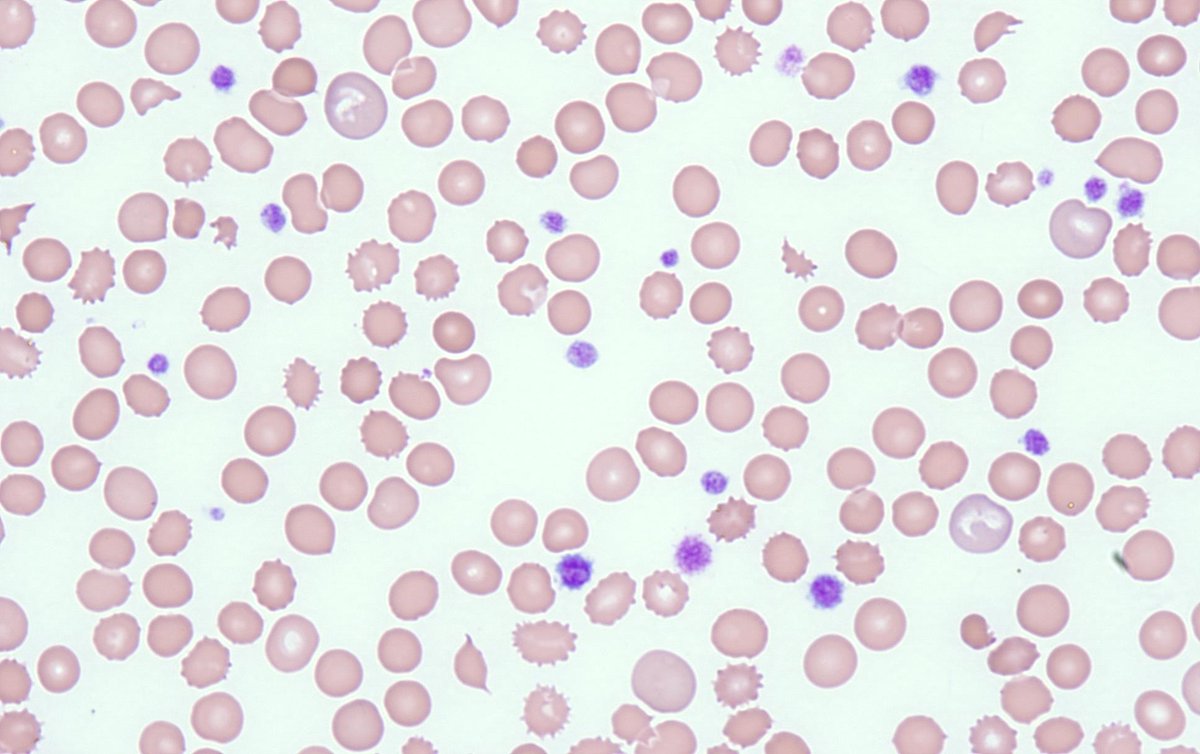 hematogones's tweet photo. My first @x post. How exciting.

Newborn, persistent thrombocytopenia. Note the uniformly enlarged, well granular platelets. This is a neat and well described finding in the context of #diGeorge syndrome. 

#hemepath #pedipath https://t.co/2EVeyw9u43