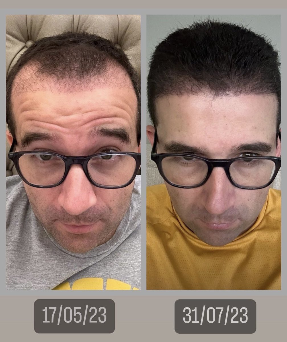 samuelvenancio's tweet photo. 😁 - vc que estava esperando pra ver o resultado já pode chamar lá na Clínica Rejuvenesce e ainda usar o código EXCALVOCELESTE pra ter R$1.000,00 de desconto tá >>> https://t.co/SBADy88sVZ https://t.co/XAO9LiFdha