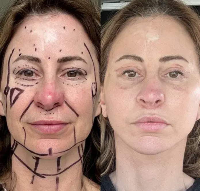 CosmeticLaneTCL's tweet photo. I sold my home for a facelift — now I look fabulous but live in a van...

Kelly Beasley, a blogger who lives in Lake Tahoe, California revealed that she sold her 3 bedroom home in Arizona so that she could pay for a Facelift.

She realized her face was dropping, fast once she hit 48 & fillers were not longer cutting it so she decided she wanted to go the surgery route.. While surgeons around her were charging 50-60k, she found someone in Mexico was only charge 14k so... she decided to sell her home & treat herself.

She opted to get an extended face lift, neck lift, lip lift, and fat transfer from her thighs.

She said she wants to share her journey in hopes that others will stop the shame surrounding plastic surgery.

“If we do too much – we’re vain or insecure, If you don’t do anything, wear make-up or do your hair, they say ‘you’ve let yourself go’.”

Worth it or nah?