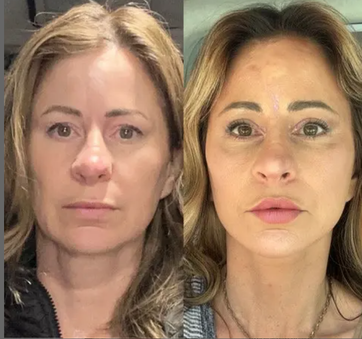 CosmeticLaneTCL's tweet photo. I sold my home for a facelift — now I look fabulous but live in a van...

Kelly Beasley, a blogger who lives in Lake Tahoe, California revealed that she sold her 3 bedroom home in Arizona so that she could pay for a Facelift.

She realized her face was dropping, fast once she hit 48 & fillers were not longer cutting it so she decided she wanted to go the surgery route.. While surgeons around her were charging 50-60k, she found someone in Mexico was only charge 14k so... she decided to sell her home & treat herself.

She opted to get an extended face lift, neck lift, lip lift, and fat transfer from her thighs.

She said she wants to share her journey in hopes that others will stop the shame surrounding plastic surgery.

“If we do too much – we’re vain or insecure, If you don’t do anything, wear make-up or do your hair, they say ‘you’ve let yourself go’.”

Worth it or nah?