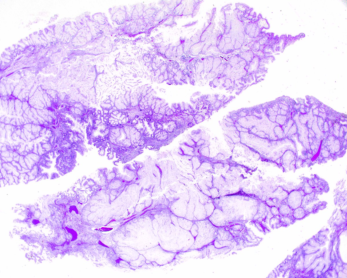 LizMontgomeryMD's tweet photo. This gastric polyp from a patient with the PTEN hamartoma/Cowden syndrome looks similar to a gastric juvenile polyp but less like a sporadic gastric hyperplastic polyp - correlation with additional studies is always indicated. https://t.co/PDaKvHg3Rr