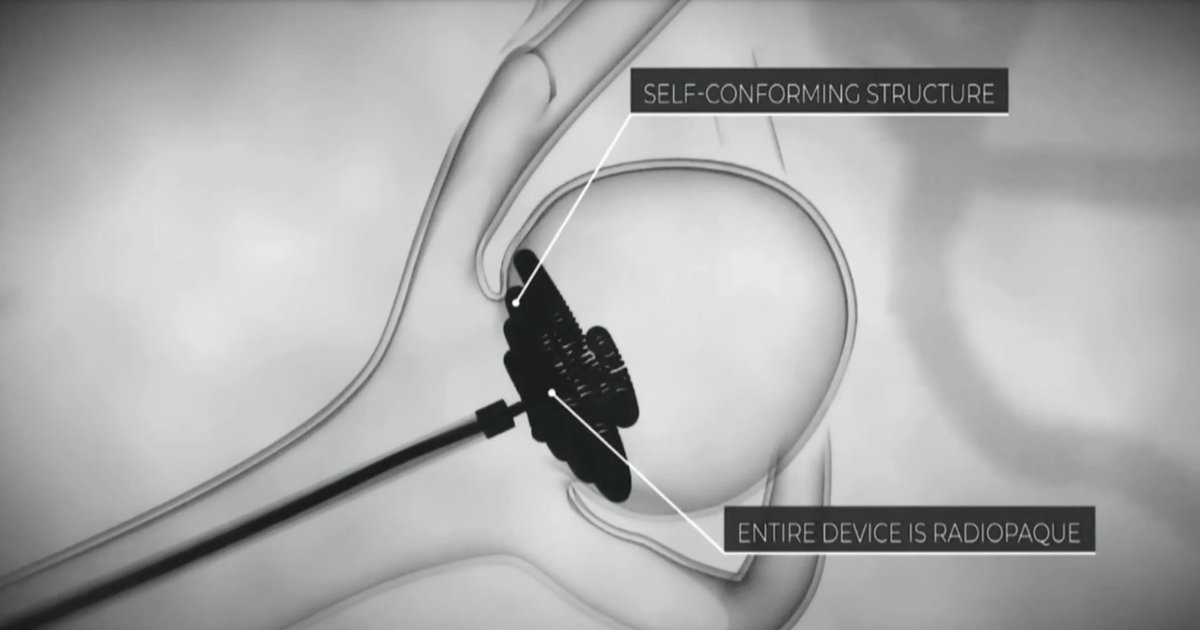 JNIS (@jnis_bmj) on Twitter photo Just around the corner: Nautilus device for aneurysm treatment by <a href="/chriskellnerMD/">Dr. Christopher Kellner</a> #SNIS2023
<a href="/JNIS_BMJ/">JNIS</a> <a href="/SNISinfo/">SNIS Info</a> <a href="/fcalbuquerque51/">Felipe C. Albuquerque</a> <a href="/ducruetaf/">Andrew Ducruet</a> <a href="/DrAltschul/">Dorothea Altschul MD FAHA FSVIN</a> <a href="/MattAmansMD/">Matthew Amans</a> <a href="/DanniDiestro/">Dr. DiestroKE</a> <a href="/aurora_cruz/">Aurora.eth</a> <a href="/MattFusco_MD/">Matt Fusco</a>
<a href="/cvsection/">CV Section</a> <a href="/esmintsociety/">ESMINT Society</a> <a href="/aggiemarie93/">Marie Williams Denslow</a> <a href="/svinsociety/">SVIN</a> Just around the corner: Nautilus device for aneurysm treatment by <a href="/chriskellnerMD/">Dr. Christopher Kellner</a> #SNIS2023
<a href="/JNIS_BMJ/">JNIS</a> <a href="/SNISinfo/">SNIS Info</a> <a href="/fcalbuquerque51/">Felipe C. Albuquerque</a> <a href="/ducruetaf/">Andrew Ducruet</a> <a href="/DrAltschul/">Dorothea Altschul MD FAHA FSVIN</a> <a href="/MattAmansMD/">Matthew Amans</a> <a href="/DanniDiestro/">Dr. DiestroKE</a> <a href="/aurora_cruz/">Aurora.eth</a> <a href="/MattFusco_MD/">Matt Fusco</a>
<a href="/cvsection/">CV Section</a> <a href="/esmintsociety/">ESMINT Society</a> <a href="/aggiemarie93/">Marie Williams Denslow</a> <a href="/svinsociety/">SVIN</a>
