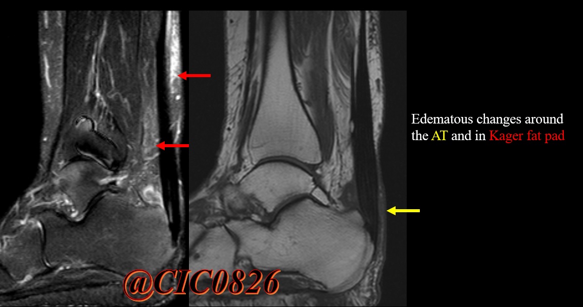 It is important to remember that the Achilles tendon lacks a synovial sheath. Instead, the inflammatory changes manifest in the Kager fat pad (peritendinitis) or around a tendon that is a synovial sheath-like structure (paratendinitis).
#MSKrad  #Achillestendon