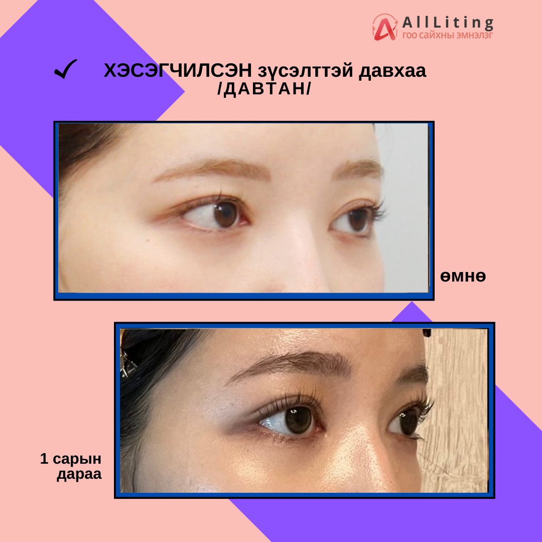 📷#НҮДНИЙ_ДАВТАН_МЭС_ЗАСЛААР_МЭРГЭШСЭН_ЭМНЭЛЭГ📷
хийлгэсэн ажилбар
📷ХЭСЭГЧИЛСЭН зүсэлттэй давхаа /ДАВТАН/
-------------------------
📷📷 ҮЗЛЭГ/ЗӨВЛӨГӨӨ үнэгүй хийж зөвхөн таньд тохирсон мэс заслын төлөвлөгөөг гаргана.
📷монгол ажилтан: 010-4931-4451