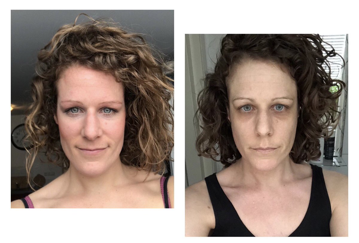 Behind this before-and-after photo lies the unyielding reality of #severeME - a debilitating condition that can silently steal your health and vitality. The contrast in appearance reflects my hidden battles.

#severeMEday 
#MECFS 
#pwME