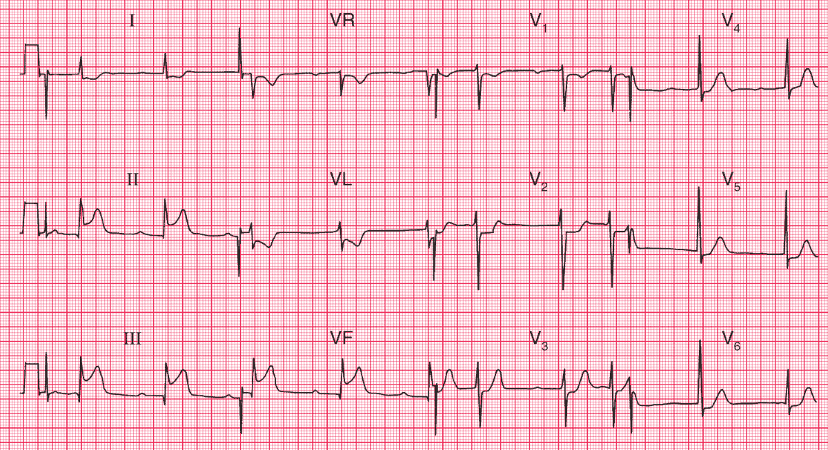 ManualOMedicine's tweet photo. A 55 y.o. man with severe central chest pain that had been present for about an hour. He was pale, cold and clammy.
- What does this ECG show?

👉 Answer and Interpretation: https://t.co/lXcOU1EgLf

#medtwitter #foamed #CardioTwitter #cardioed https://t.co/B1wgQvUdHy