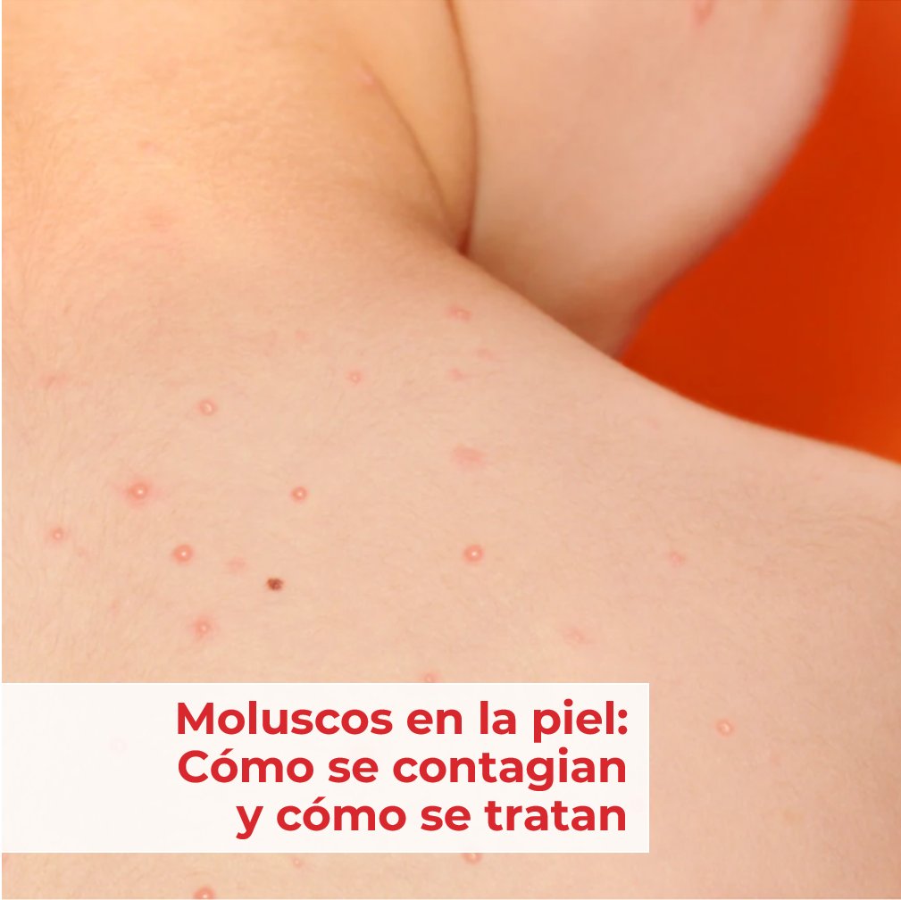 El Virus del Molusco Contagioso es una infección de la piel que se propaga tocando a personas infectadas o cosas que tocaron. ¿Quieres saber cómo tratarlo y cómo evitar el contagio? >> bit.ly/43Vl3HT #CuidadoDeLaPiel