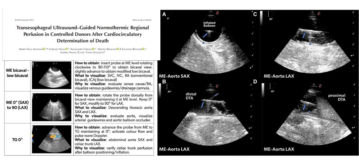 Transesophageal #ultrasound guided normothermic regional perfusion in cDCD donors, how we do it: detailed description of technique we use for #EISOR (is also worth reading if you use #REBOA), just out, open access, on @asaiojournal 🔓 bit.ly/TEUcDCD 🖥️ guidewires & EBOA…