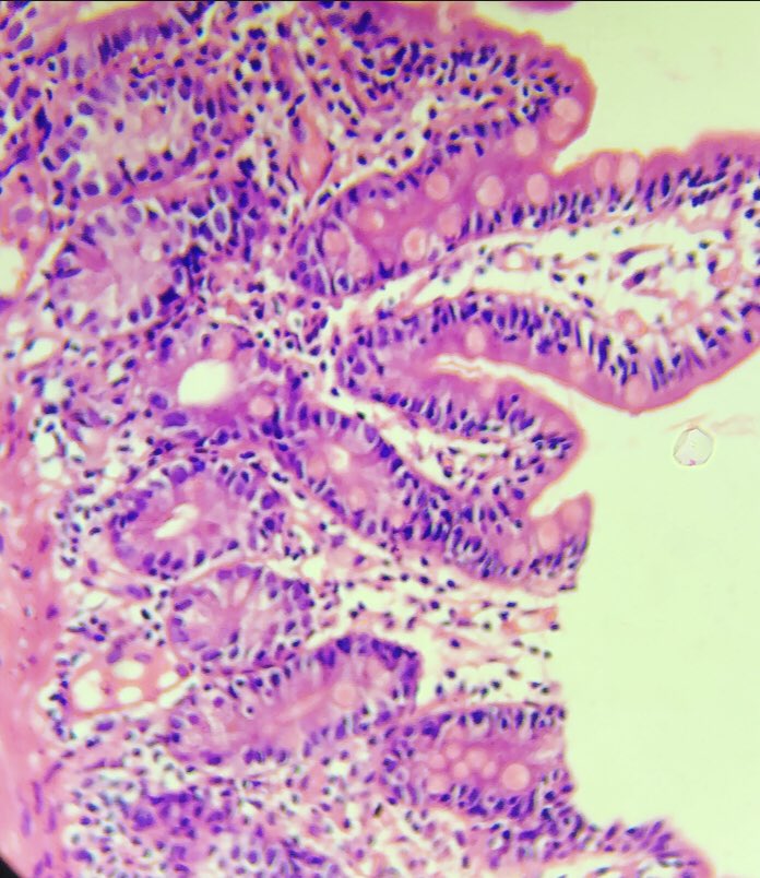 DrKumarVicky's tweet image. 🔬ileal biopsy

#TwitterPath