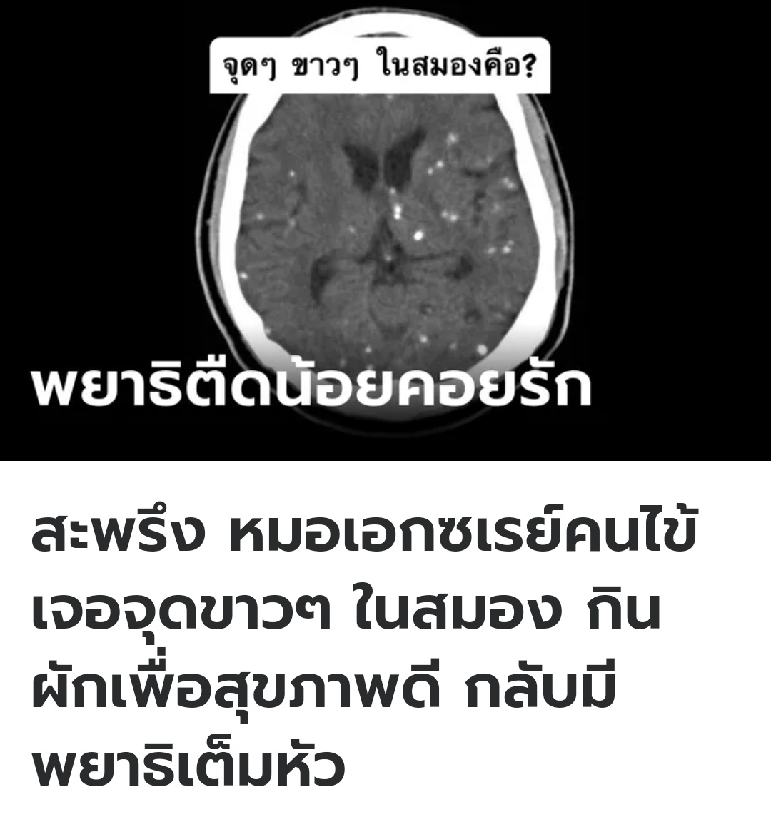 คุณหมอมาแชร์ประสบการณ์  เผยภาพเอกซ์เรย์ พบว่ามีจุดขาวๆ เต็มไปหมดนั่นคือพยาธิตัวตืดที่กำลังขึ้นสมอง ส่งผลให้ ปวดหัว ชัก หมดสติได้ ขอให้ล้างผักให้สะอาด ทานอาหารปรุงสุก หลีกเลี่ยงการทางของดิบนะครับ