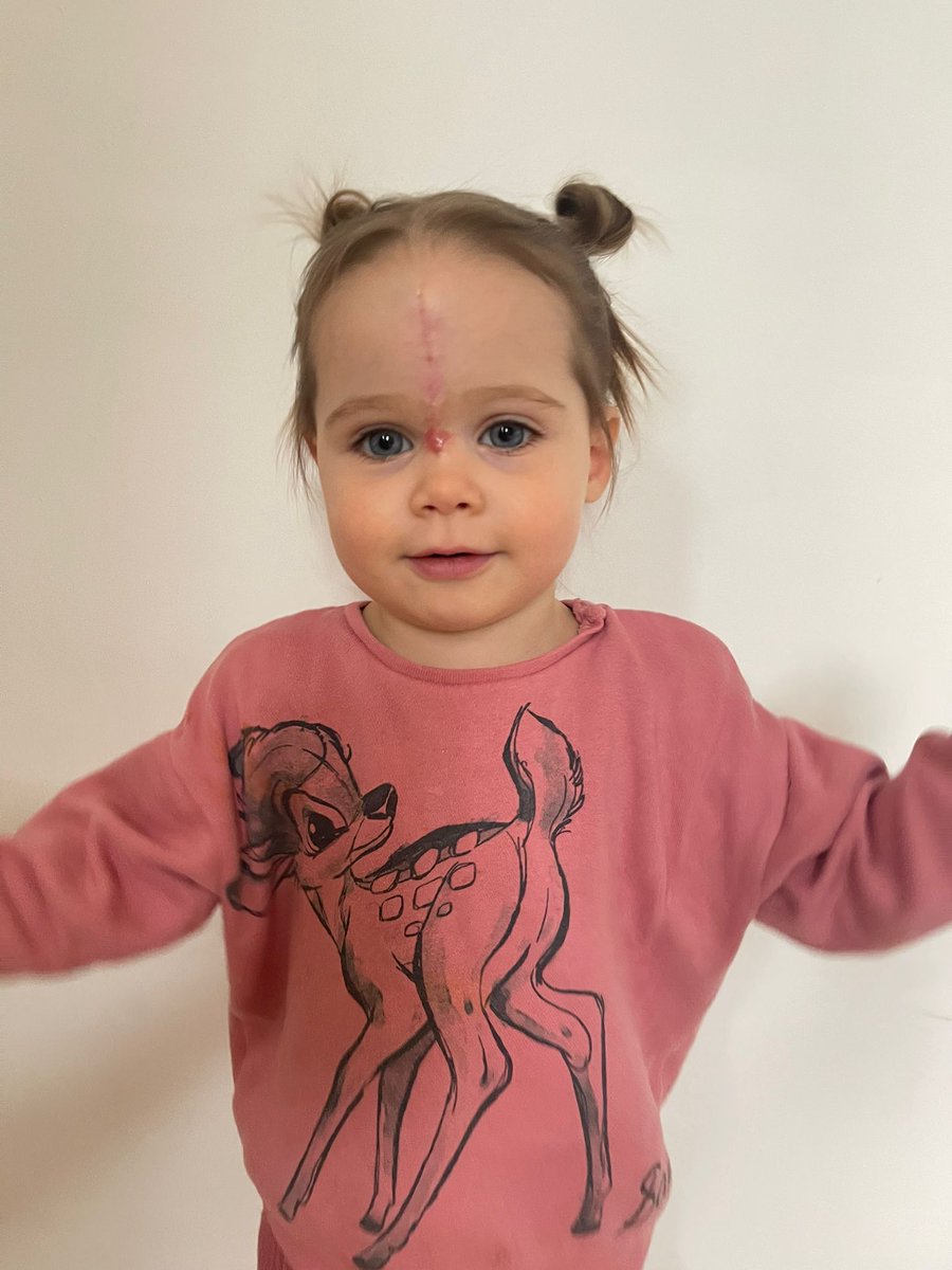 “I don’t want others to feel as alone as we did.”

Celine’s daughter, Vienna, was born with a rare birthmark known as a CMN. Today, Celine shares her experiences.

ow.ly/ZyeX50PmxHW
