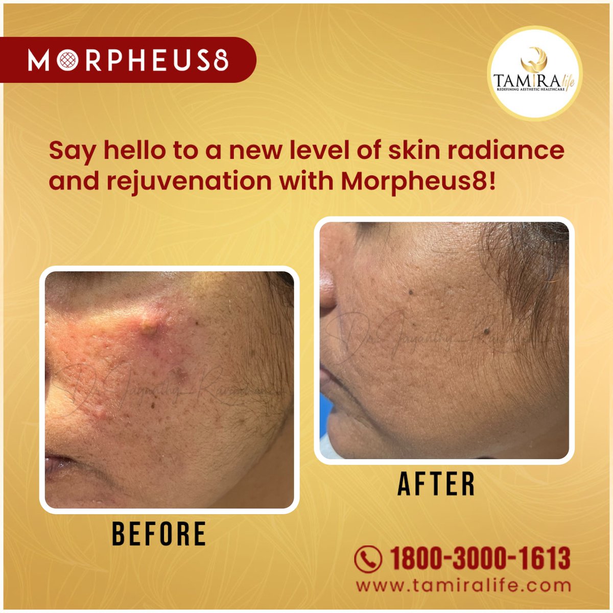 Say hello to a new level of #skinradiance and #rejuvenation with #Morpheus8!
Morpheus 8 is an innovative and cutting-edge #aesthetictreatment that combines #microneedling and #radiofrequency (RF) technology to rejuvenate and transform the #skin. 
For more details: 1800 3000 1613