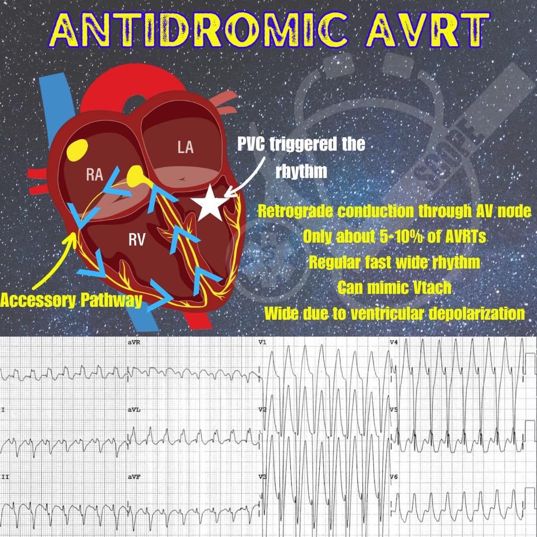 Common arrhythmia in WPW patients. Here is how it occurs! 

#FOAMed #nurse #paramedic #medical #meded #medicaleducation #criticalcare #flightnurse #criticalcaremedicine #emergencynursing #medicine #ambulance #physician #physicianassistant #ecg #ekg #wpw #avrt #cardiology