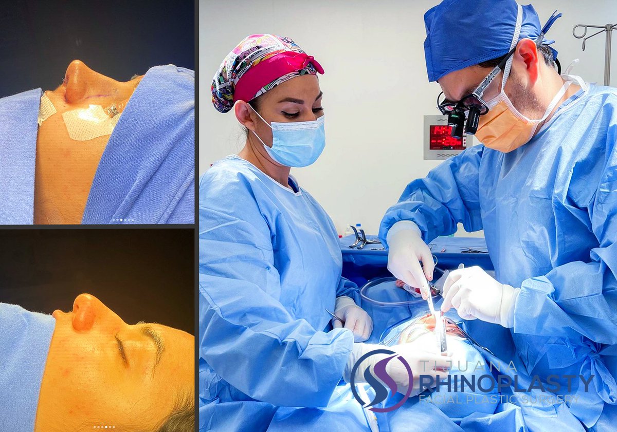 strictlyfaces's tweet photo. Tijuana Rhinoplasty | Dr. Edgar Eduardo Santos
https://t.co/1xDZIUa79P
Tijuana Rhinoplasty in Tijuana, Mexico, is dedicated exclusively to facial plastic surgery. Dr. Edgar E. Santos specializes in rhinoplasty and revision rhinoplasty.
#rhinoplasty #Tijuana https://t.co/5cnJIkWkVa