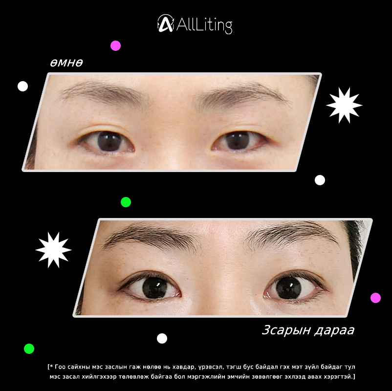 #ҮЙЛЧЛҮҮЛЭГЧИЙН_БОДИТ_ҮР_ДҮН
#ALL_Liting
хийлгэсэн ажилбар
📷зүсэлттэй давхраа
-------------------------
📷📷 ҮЗЛЭГ/ЗӨВЛӨГӨӨ үнэгүй хийж зөвхөн таньд тохирсон мэс заслын төлөвлөгөөг гаргана.
📷монгол ажилтан: 010-4931-4451