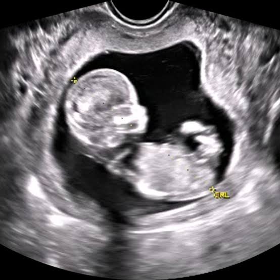 Dr_AustinOmondi's tweet photo. We have all seen these images of an ultrasound whether in hospital or in movies bring done of pregnant ladies. But why exactly are they done? Here's why.

Ultrasounds may be used at various points during pregnancy, including:

First trimester - ultrasound performed within the first 3 months of pregnancy is used to check that the embryo is developing inside the womb (rather than inside a fallopian tube, for example), confirm the number of embryos, and calculate the gestational age and the baby’s due date.

Second trimester - ultrasound performed between weeks 18 and 20 is used to check the development of fetal structures such as the spine, limbs, brain and internal organs. The size and location of the placenta is also checked. The baby’s sex can be established, if the parents wish to know.

Third trimester - ultrasound performed after 30 weeks is used to check that the baby is continuing to grow at a normal rate. The location of the placenta is checked to make sure it isn’t blocking the cervix.

RT to create awareness ✅