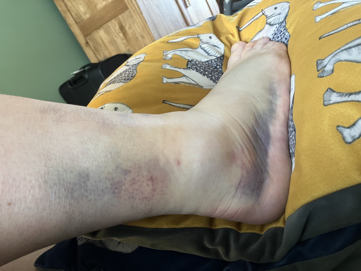 The great Forrest Gump said: "Life is like a box of chocolates". Today is 12 days since I broke my ankle while going to the lab. Today I have been told no surgery needed. Today I should have been going on holiday with my friends and family. Today I am promoted to Senior Lecturer.